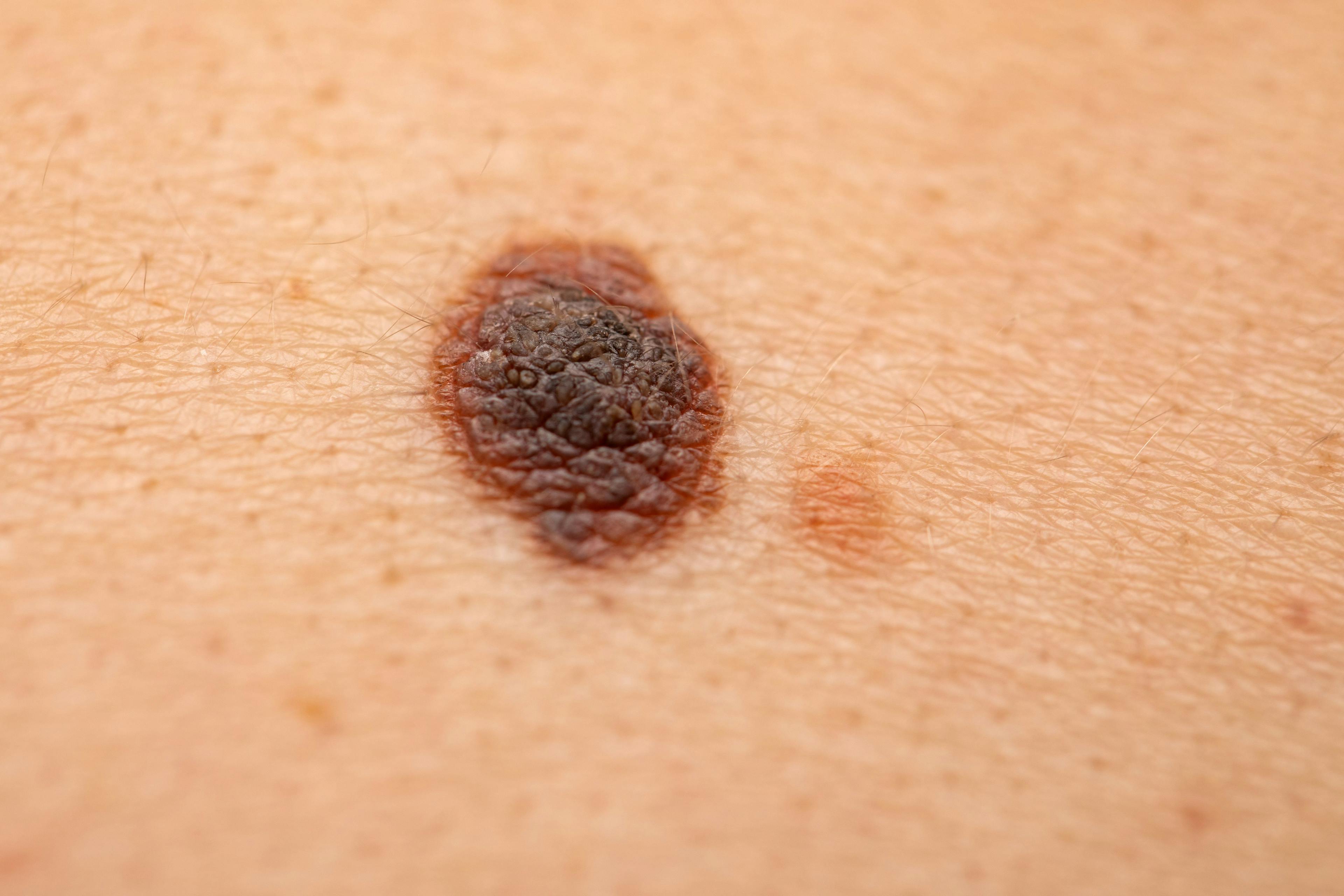 Close-up view of melanoma on the skin