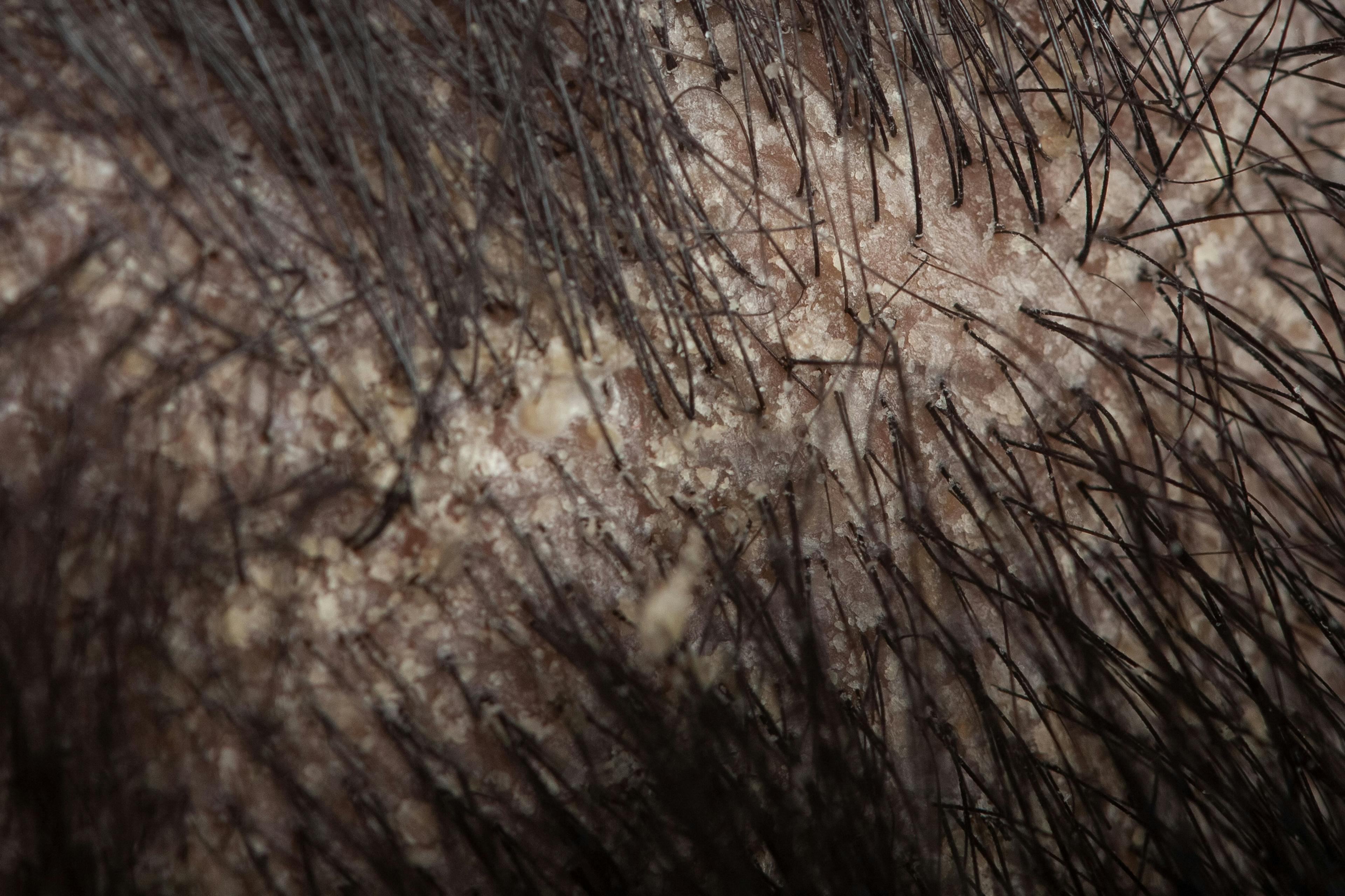 Expert Panel Confirms Efficacy and Safety of Roflumilast Topical Foam for Seborrheic Dermatitis Across Diverse Hair Types