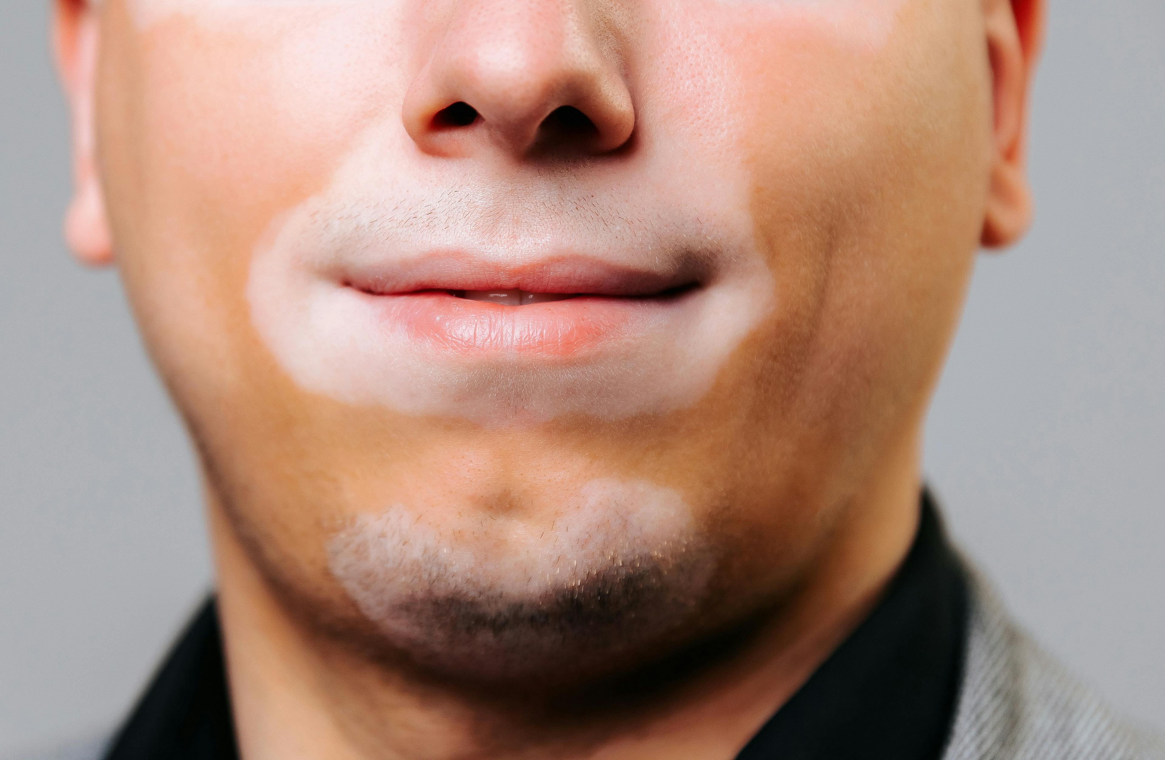 Close up front view part of the face of a young man with vitiligo on a gray background studio shot