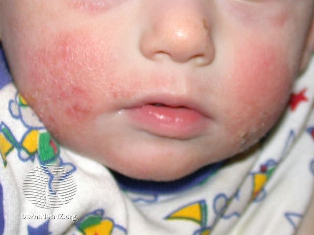 Infantile atopic dermatitis on the cheeks

Image courtesy of DermNet