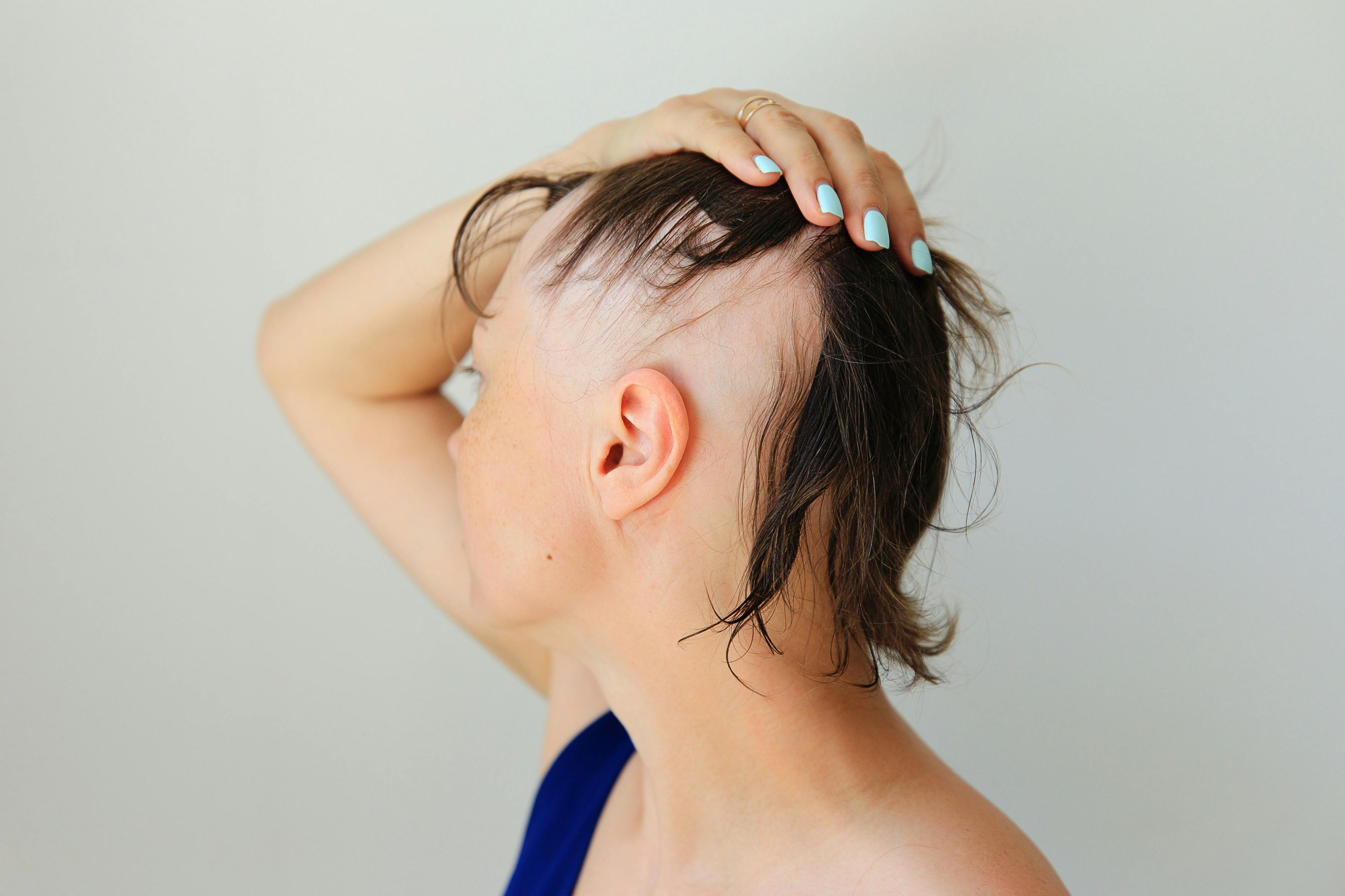 Continuing Medical Education: 3 Things You Should Know About Managing Alopecia Areata