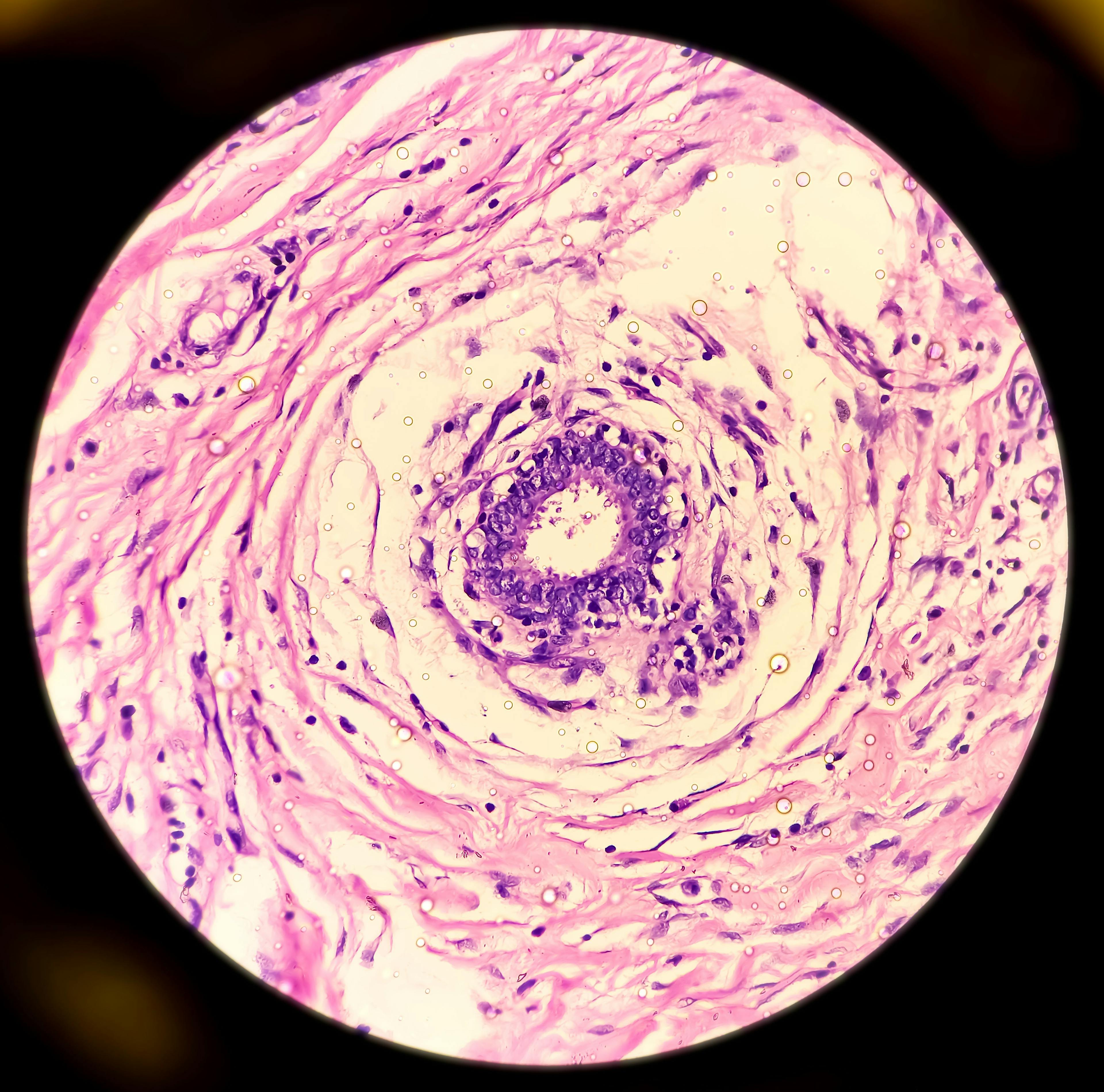 Microscopic image of hidradenitis suppurativa in axillary mass tissues | Image Credit: MdBabul/Adobe Stock
