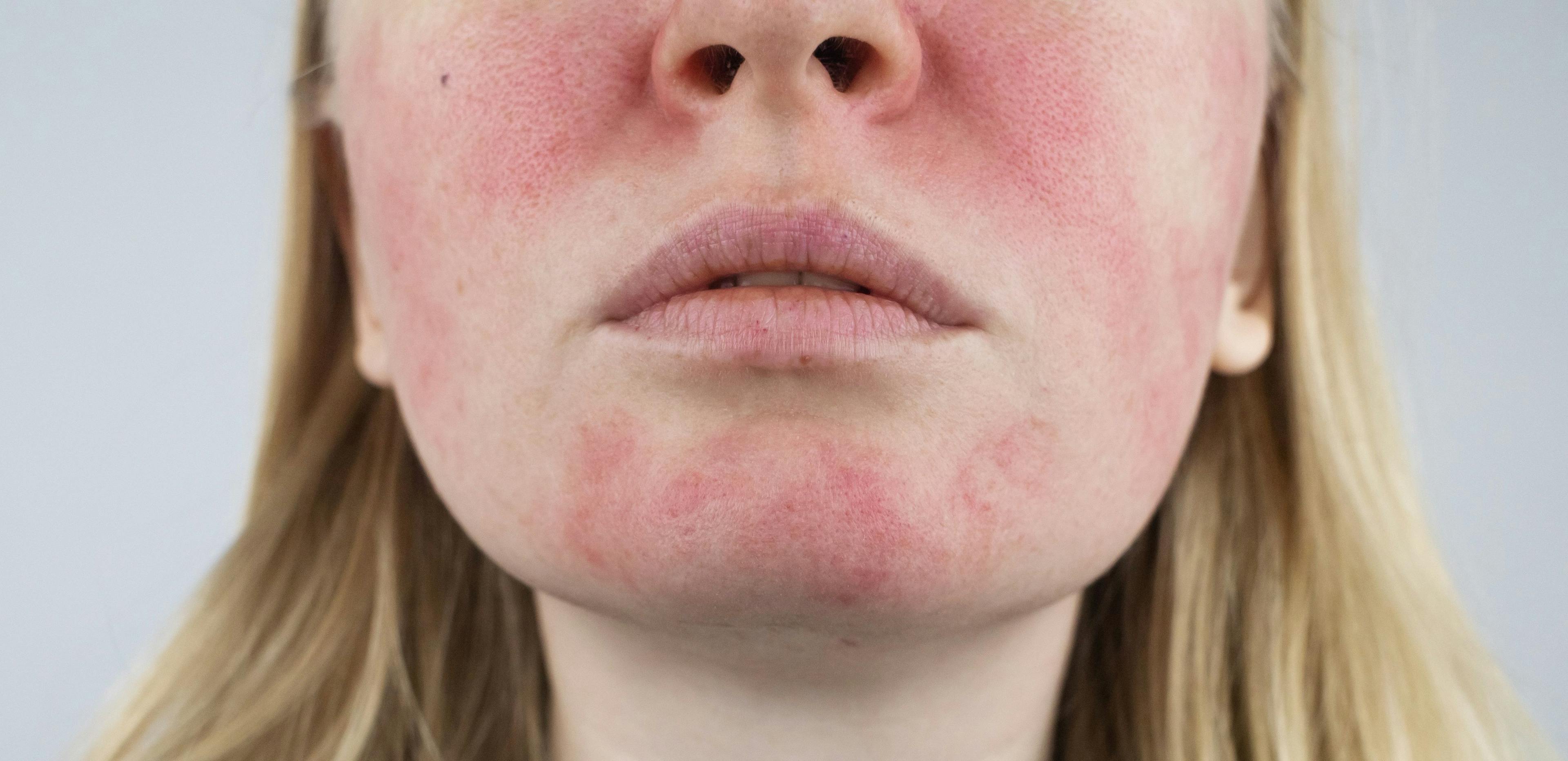 Close up view of woman with rosacea on the cheeks and face