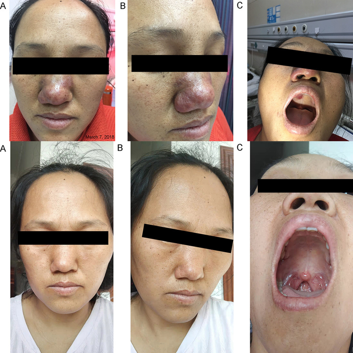 Jessner’s Lymphocytic Infiltration of the Skin Mimicking Rosacea: A Rare Case Presentation