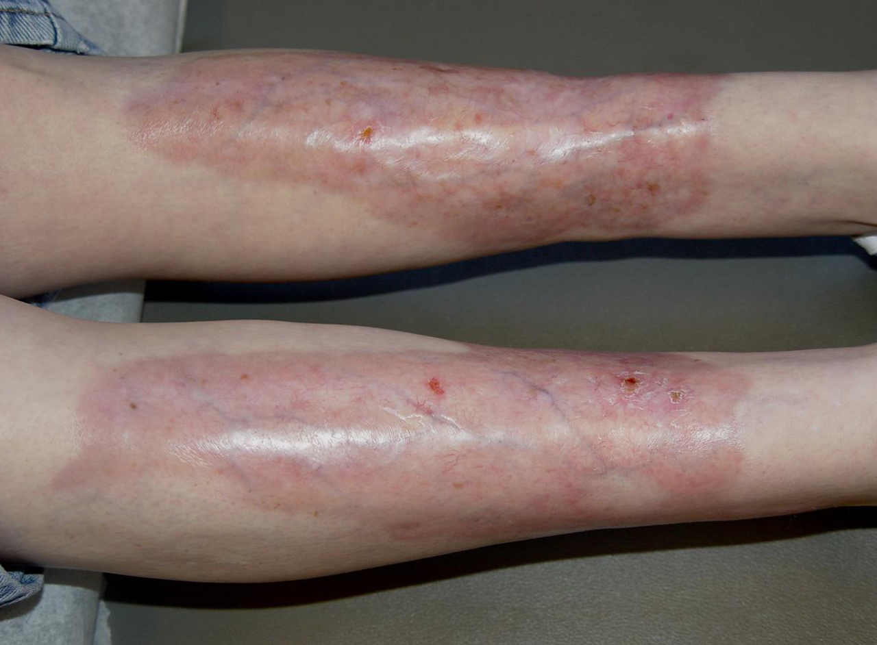 Figure 2: The bilateral shins with large, shiny, yellow-red confluent plaques with overlying telangiectasias, prominent veins, and few scattered erosions.