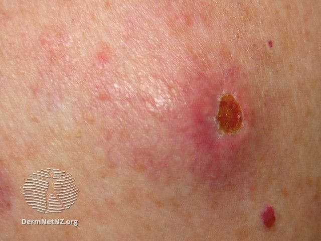 Metastatic melanoma | Image credit: DermNet