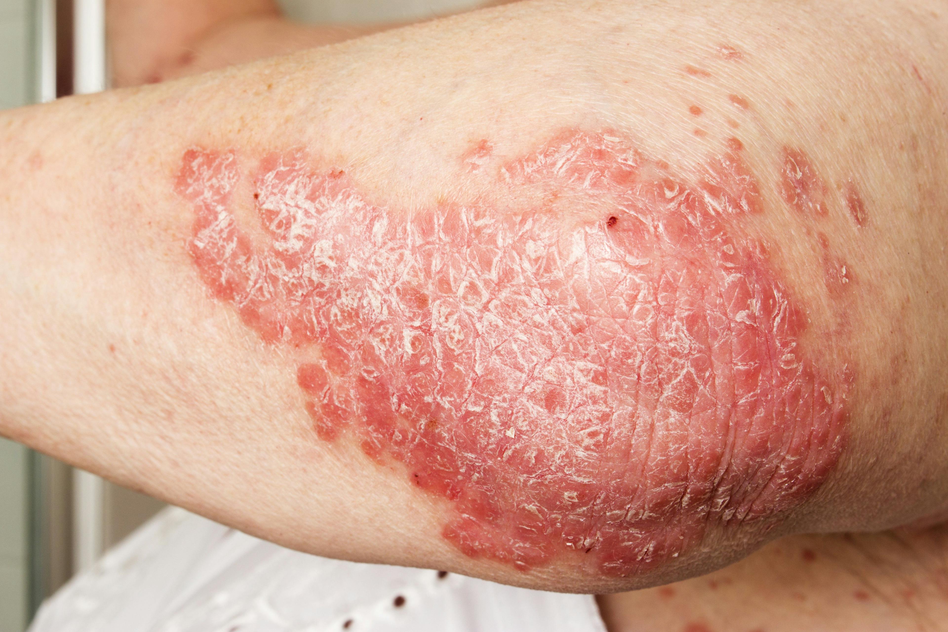 Treatment protocols may differ in early and late onset psoriasis