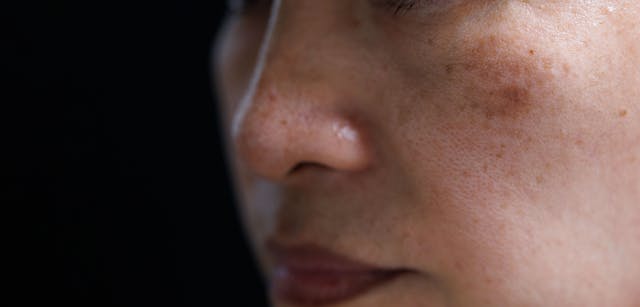 Study Becomes First to Demonstrate Efficacy of Topical Isoniazid in Melasma