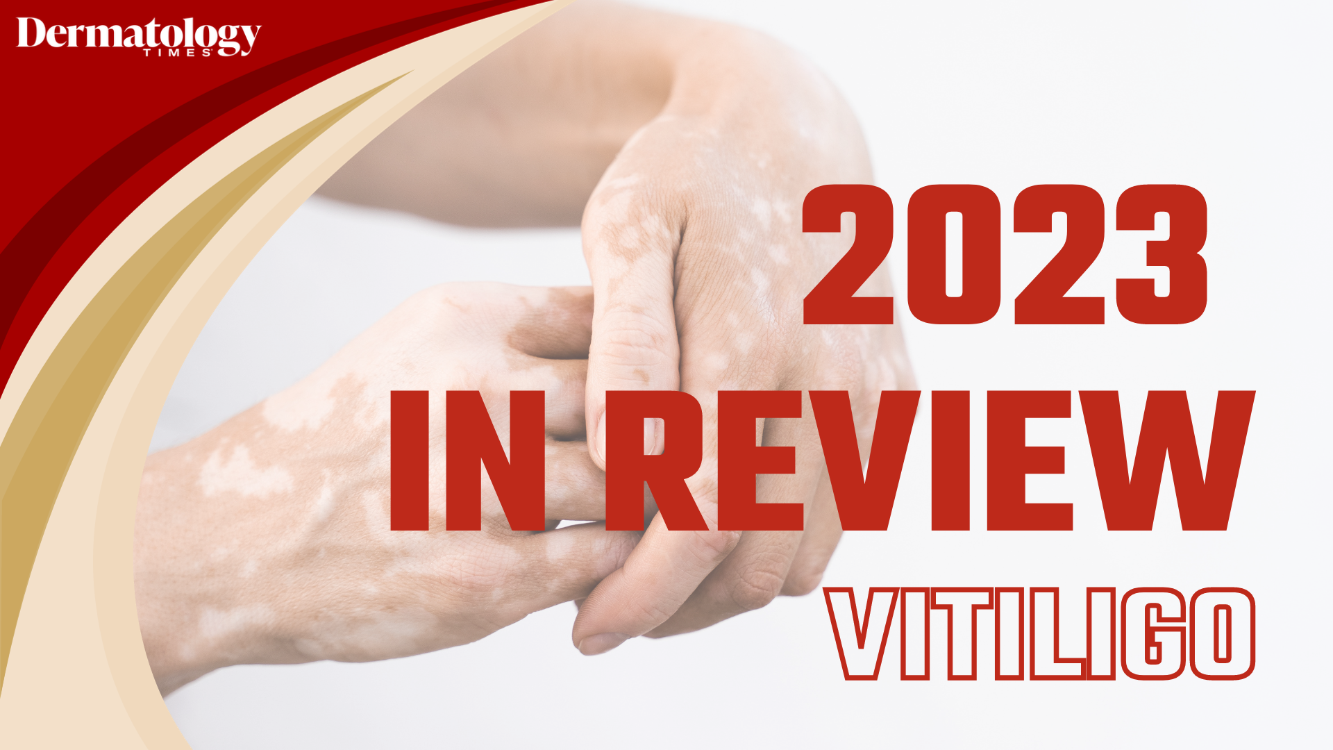 Dermatology Times 2023 In Review: Vitiligo 