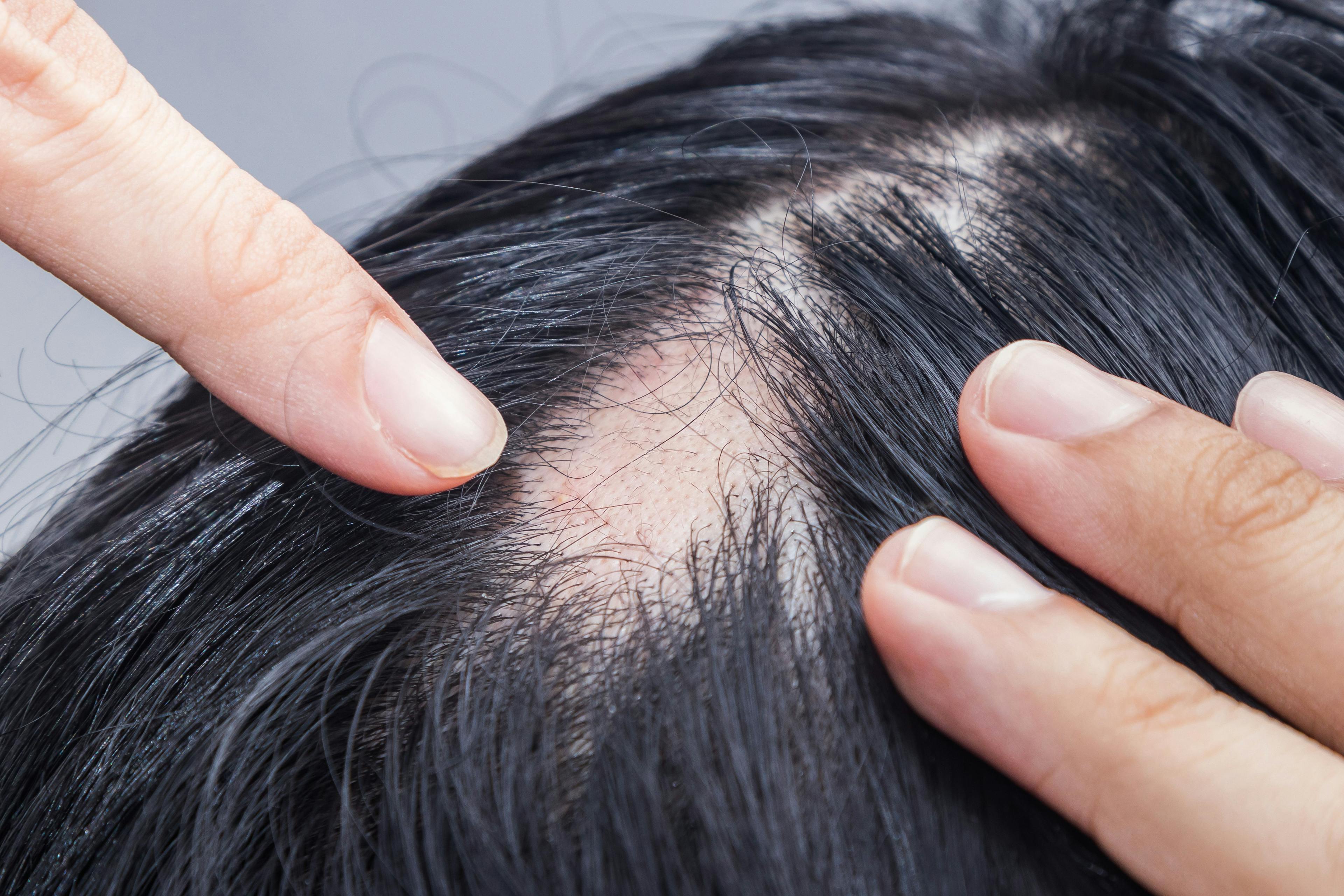 Treat the Medical and Mental Health Challenges of Alopecia
