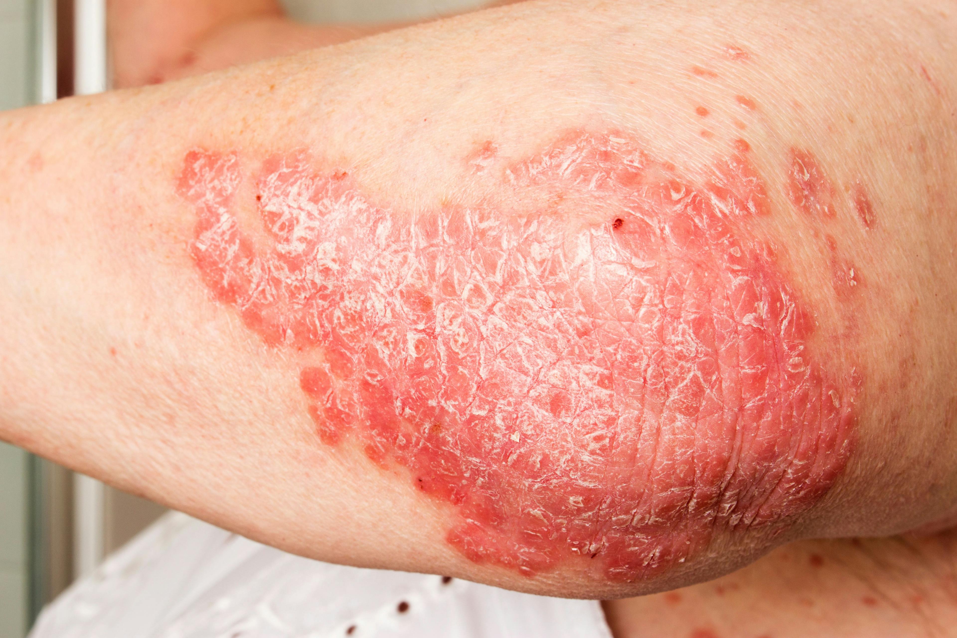 Psychological Support for Patients With Psoriasis Significantly Expedites Post-Surgery Wound Healing
