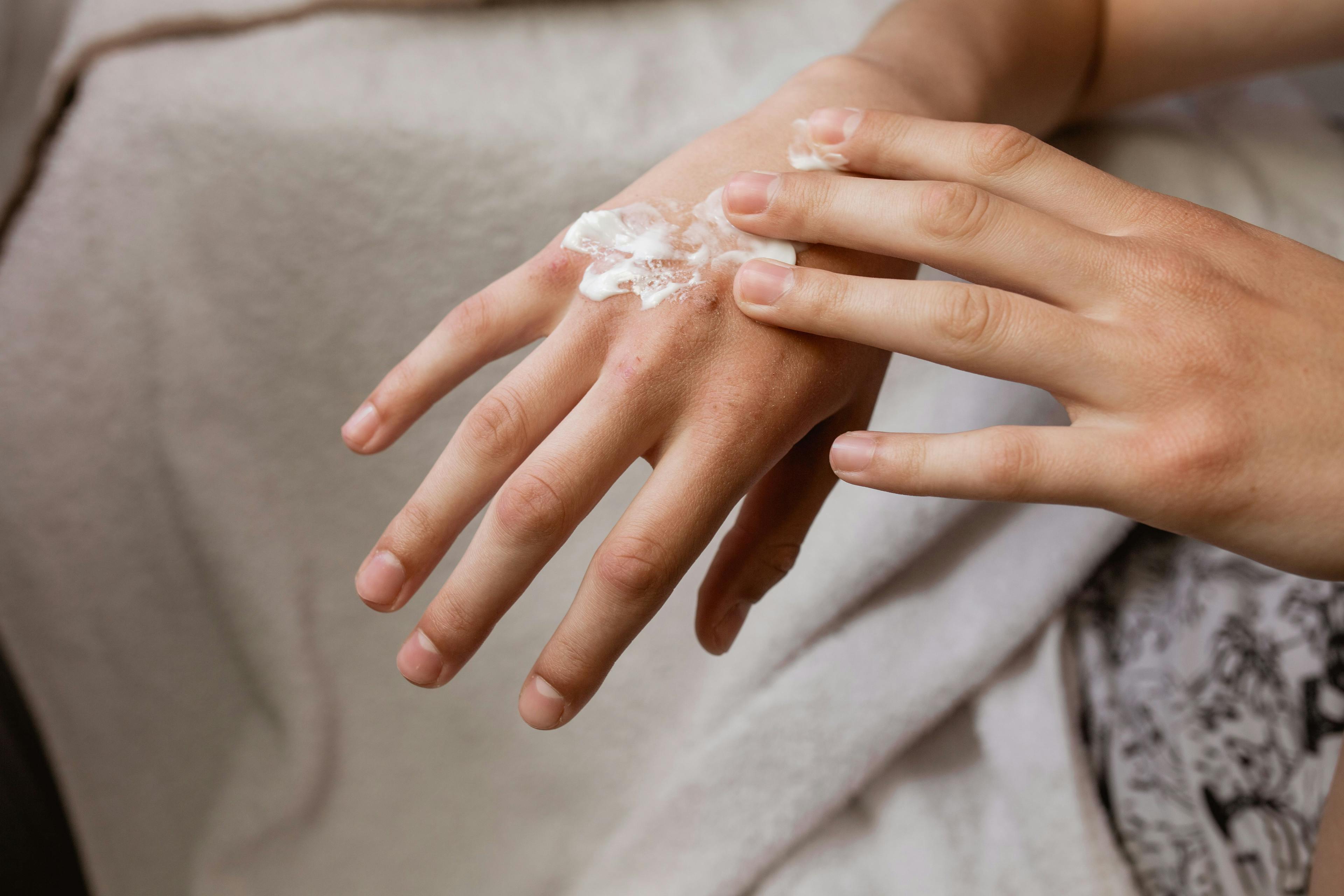 Topical Sulfur Cream 2.0% Demonstrates Equal Efficacy in Hand Eczema as Triamcinolone 0.1% Cream