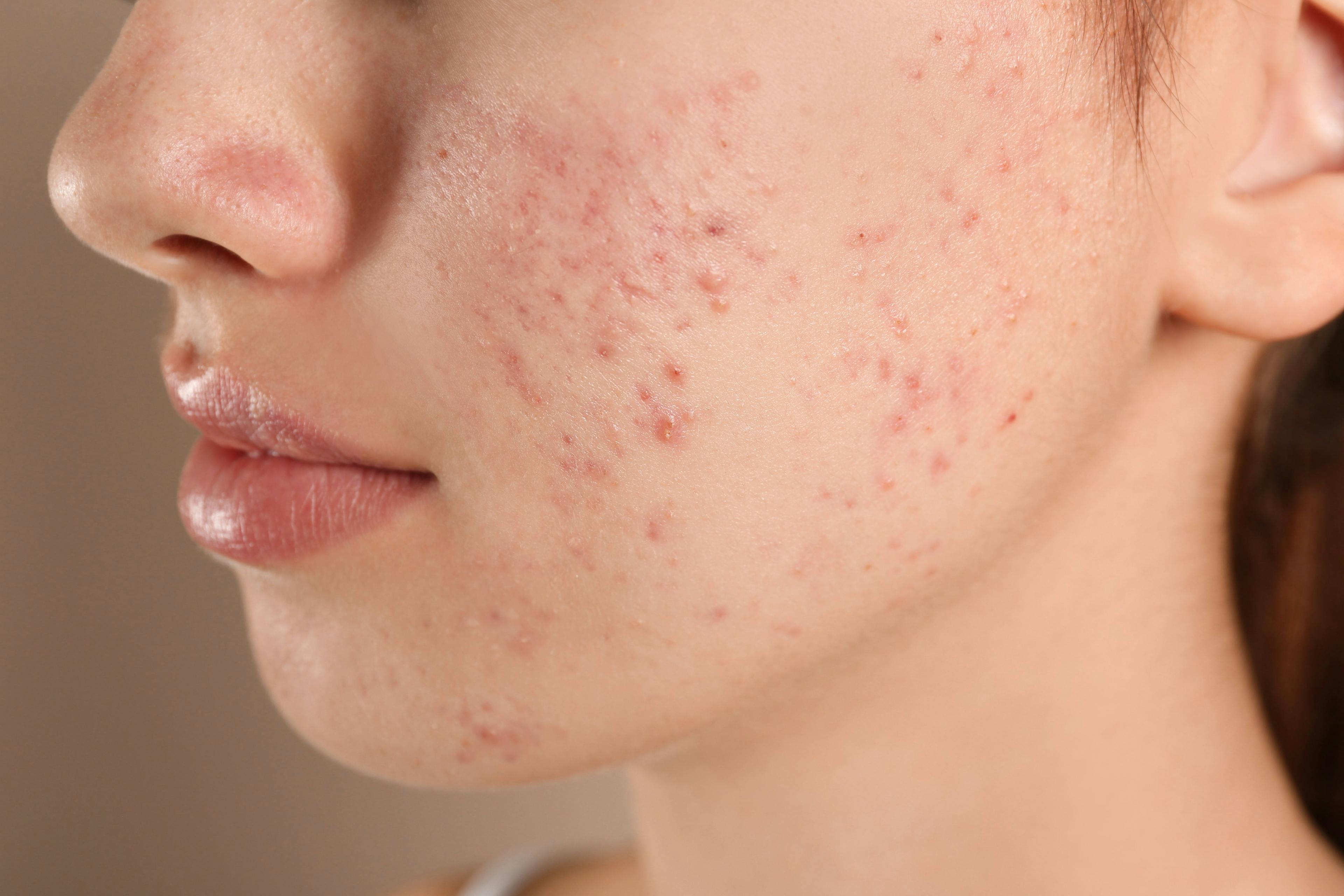 When Peels Beat Lasers for Acne Scarring, Other Conditions