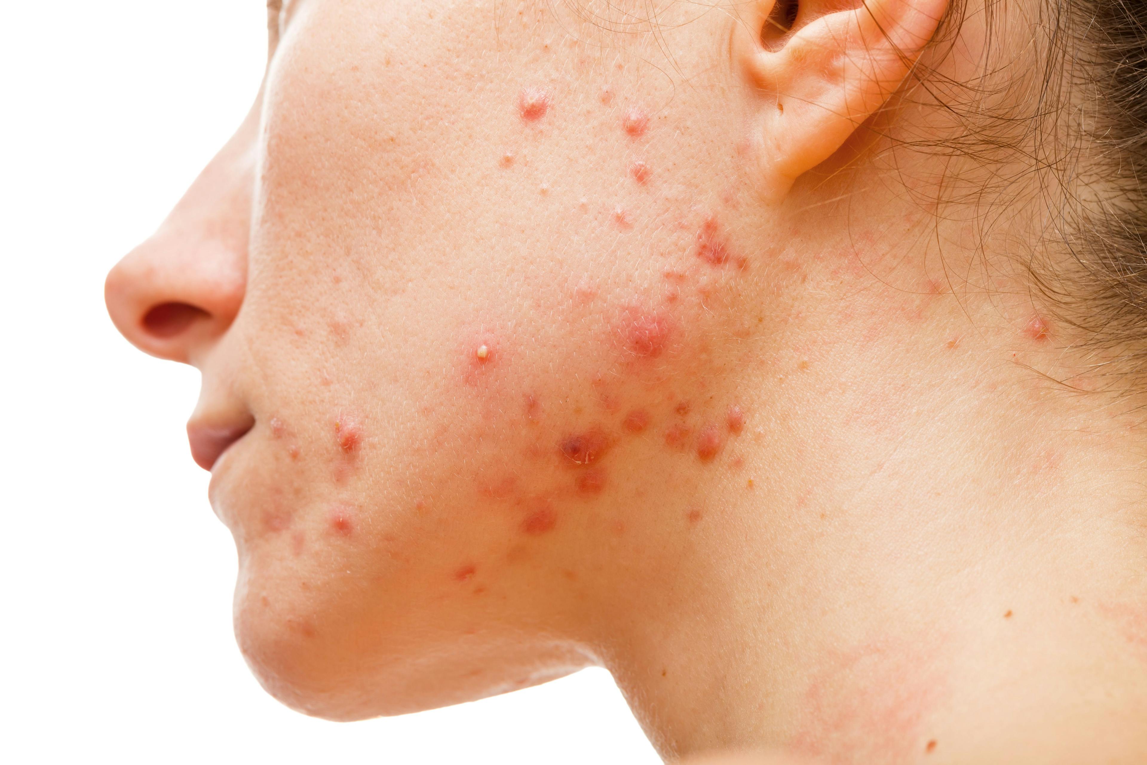 POLL: What is your preferred acne treatment?