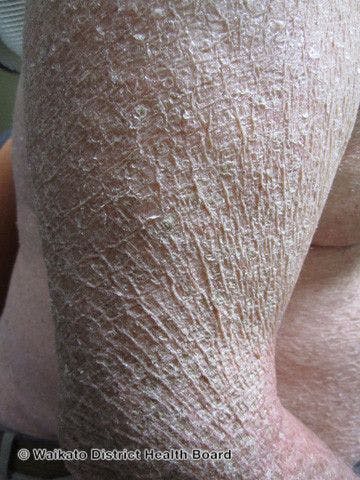 Managing Ichthyosis in the General Dermatology Office 