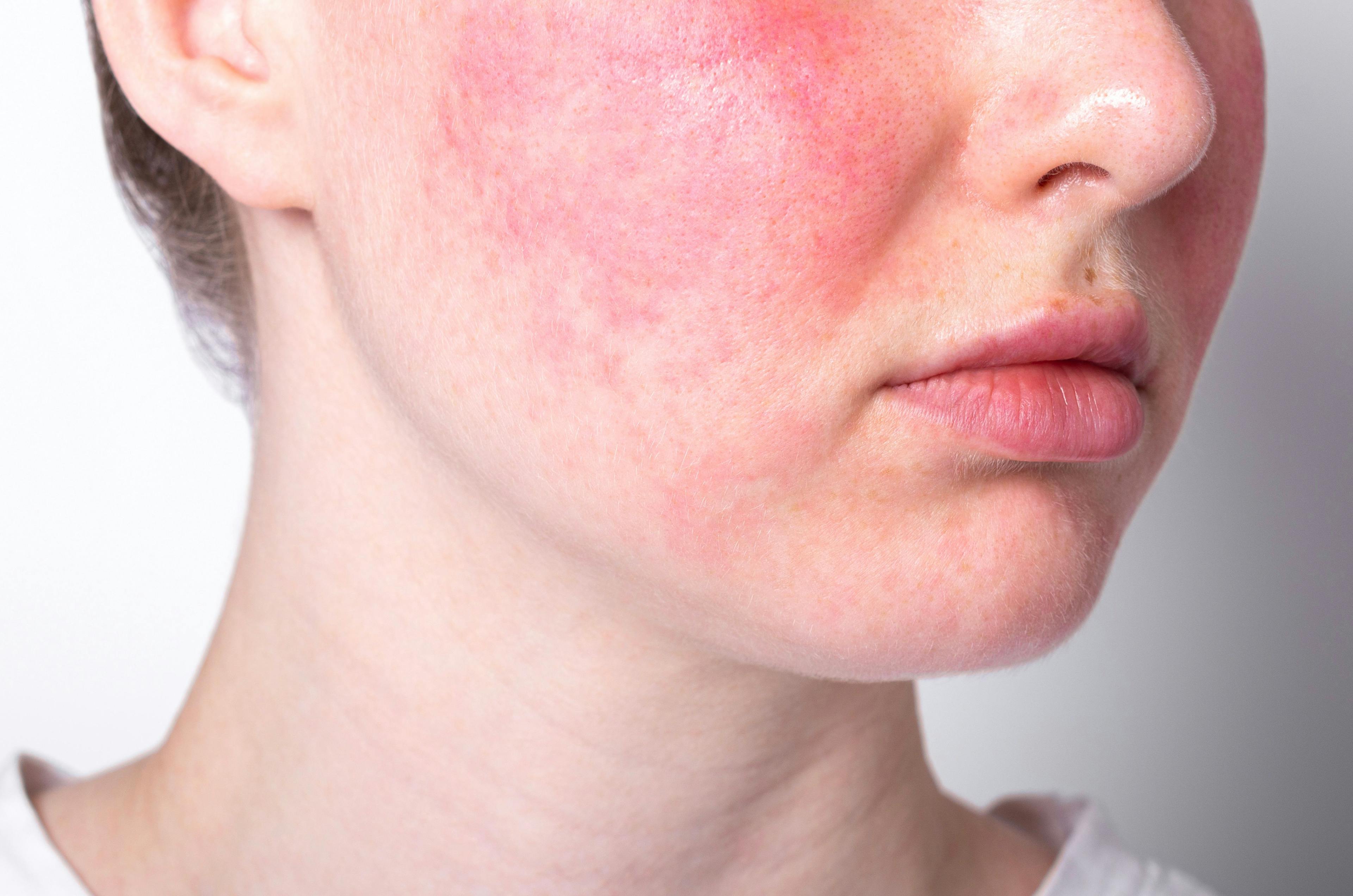 Woman with rosacea on the face