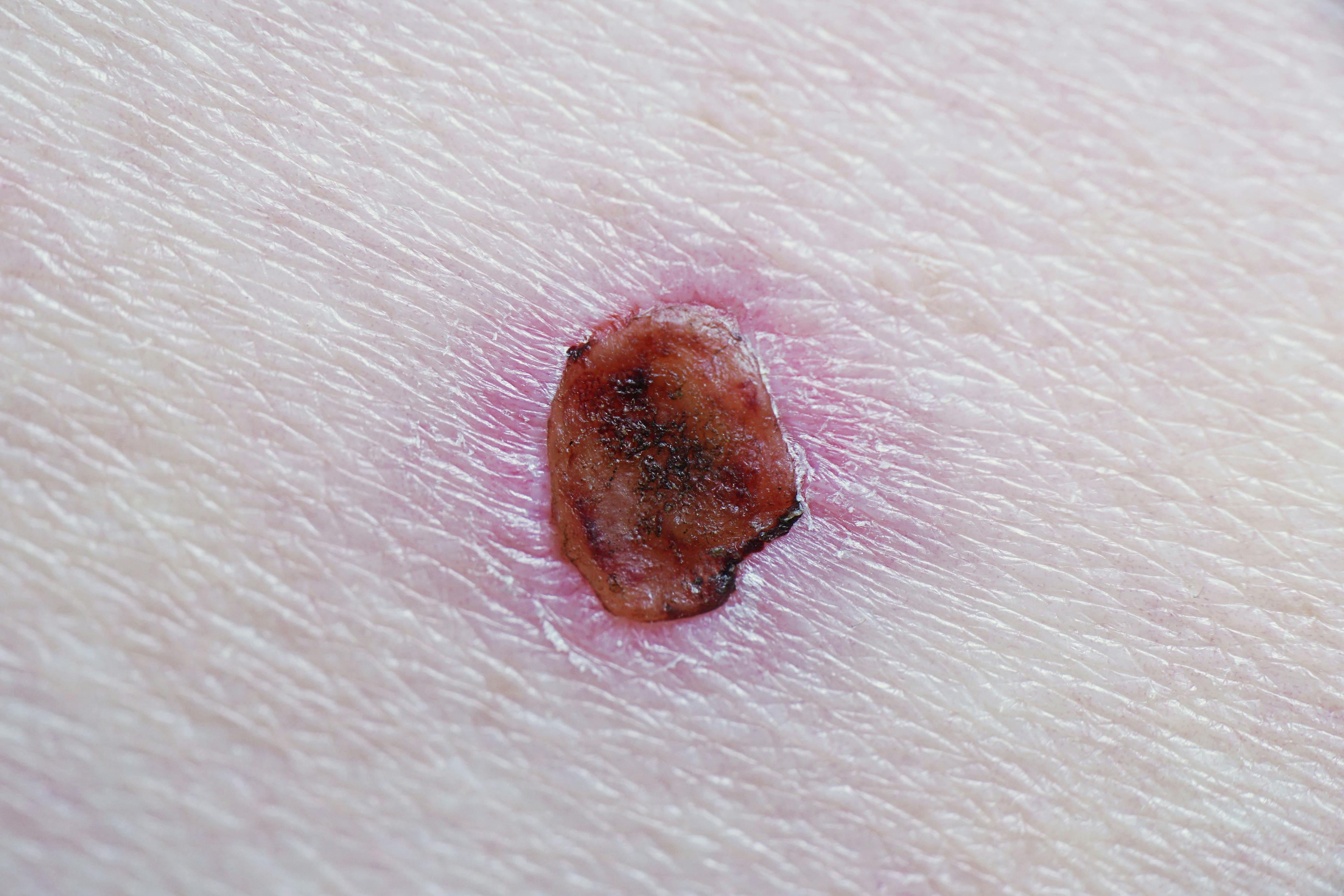 New Directions in the Treatment of Basal Cell Carcinoma