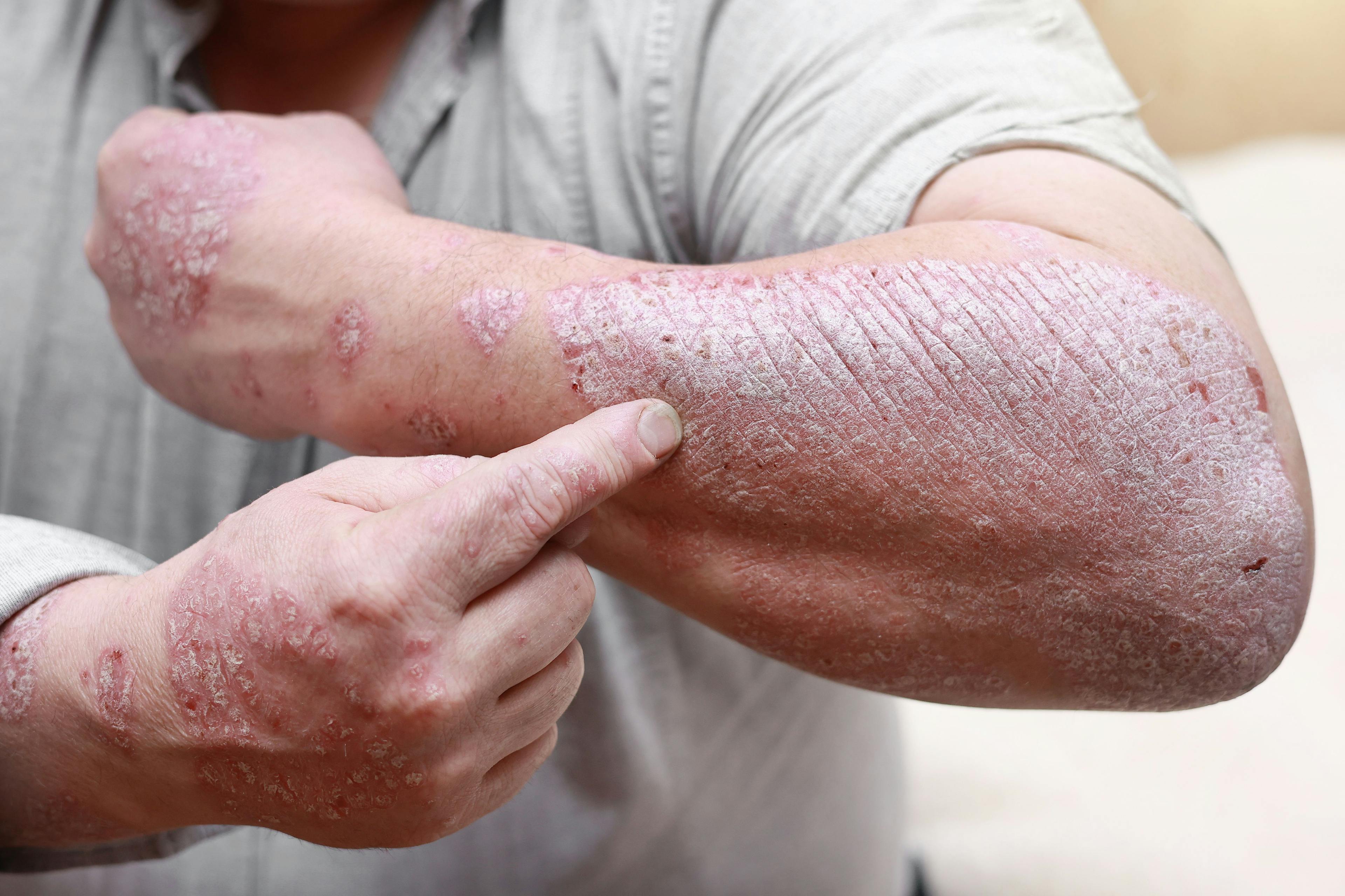 First Patient Dosed in Phase 2a Trial of AX-158 for Psoriasis