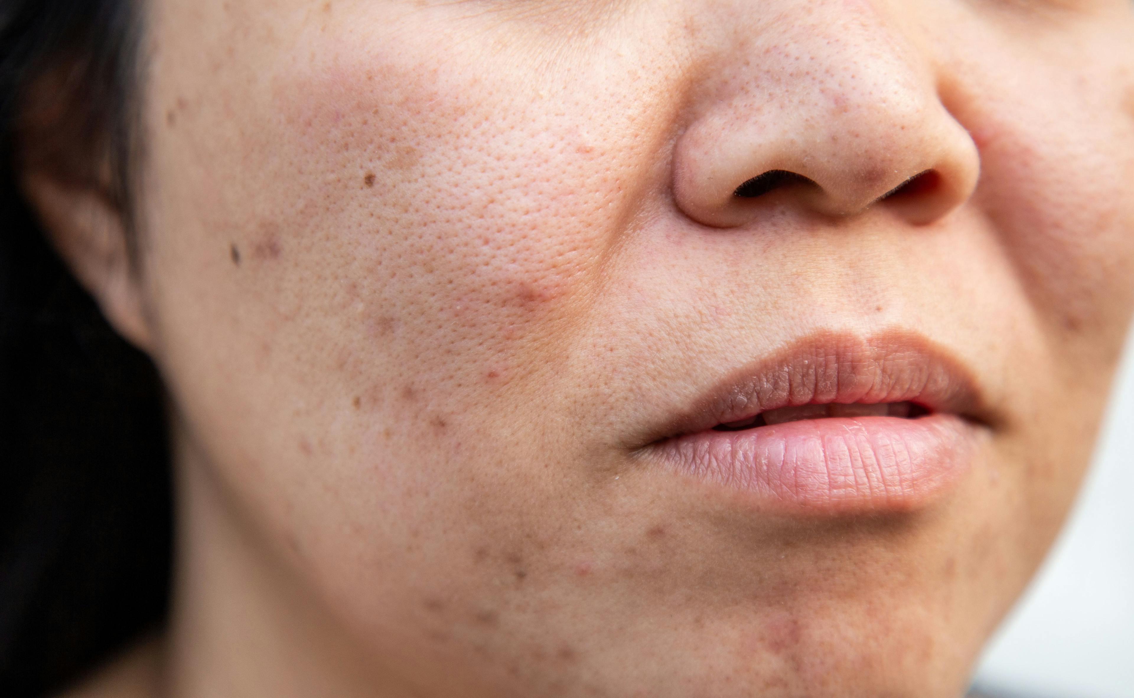 The Role of Pharmacists in Providing Patient Counseling On Topical Niacinamide For Acne and More