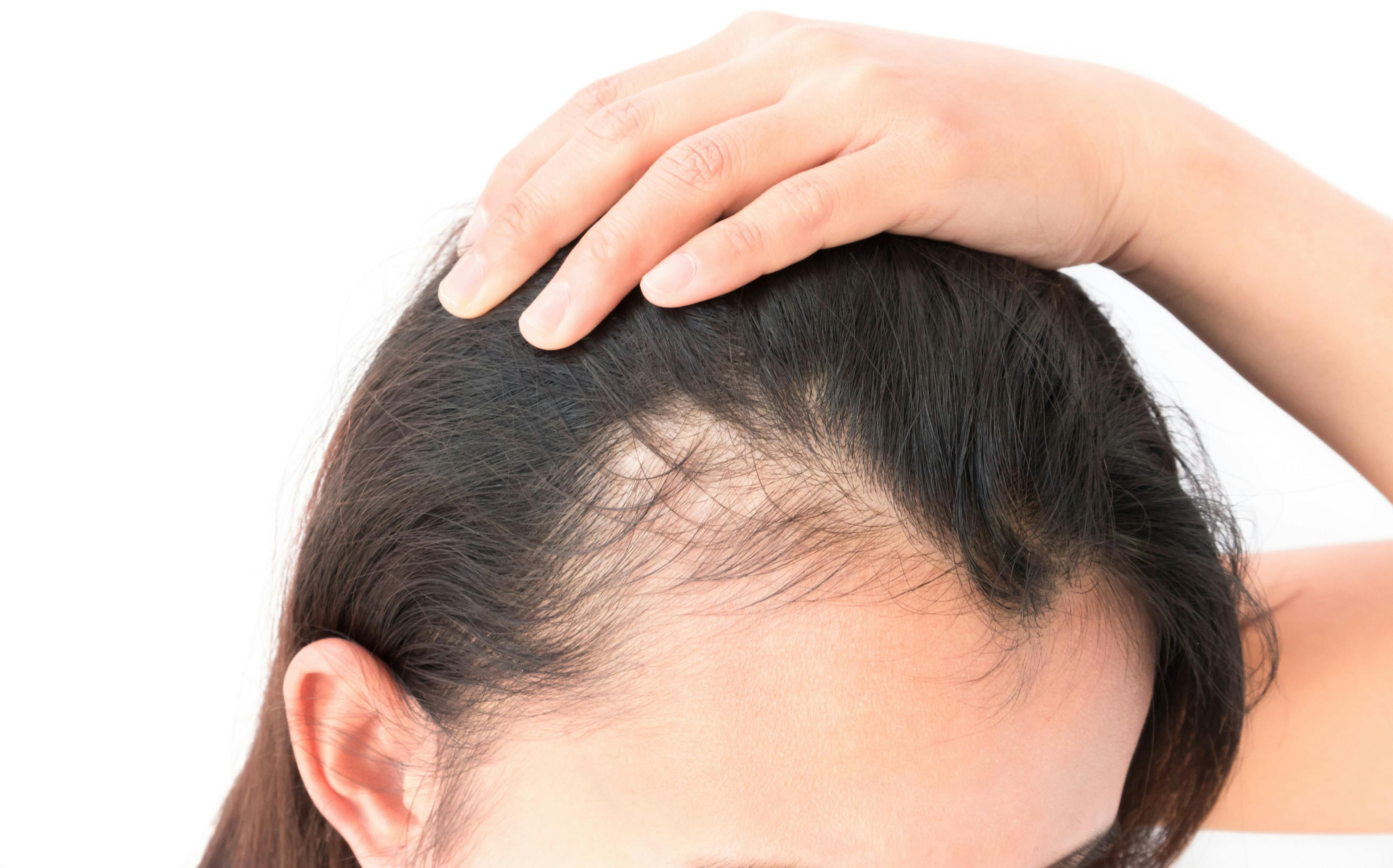 Expert Advice: Don’t Shrug Off Postpartum Hair Loss