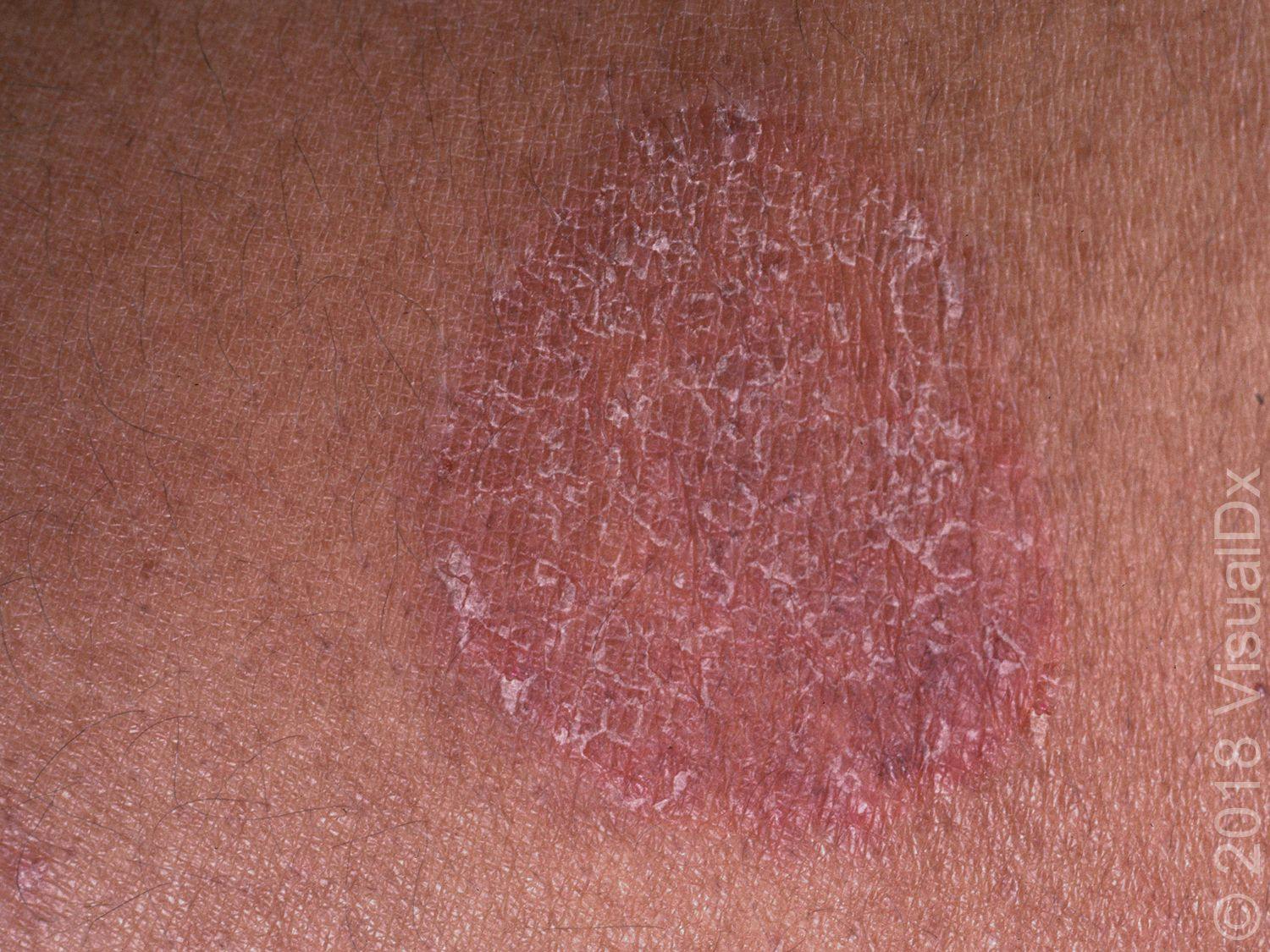 Image IQ: Widespread brown macules on the trunk