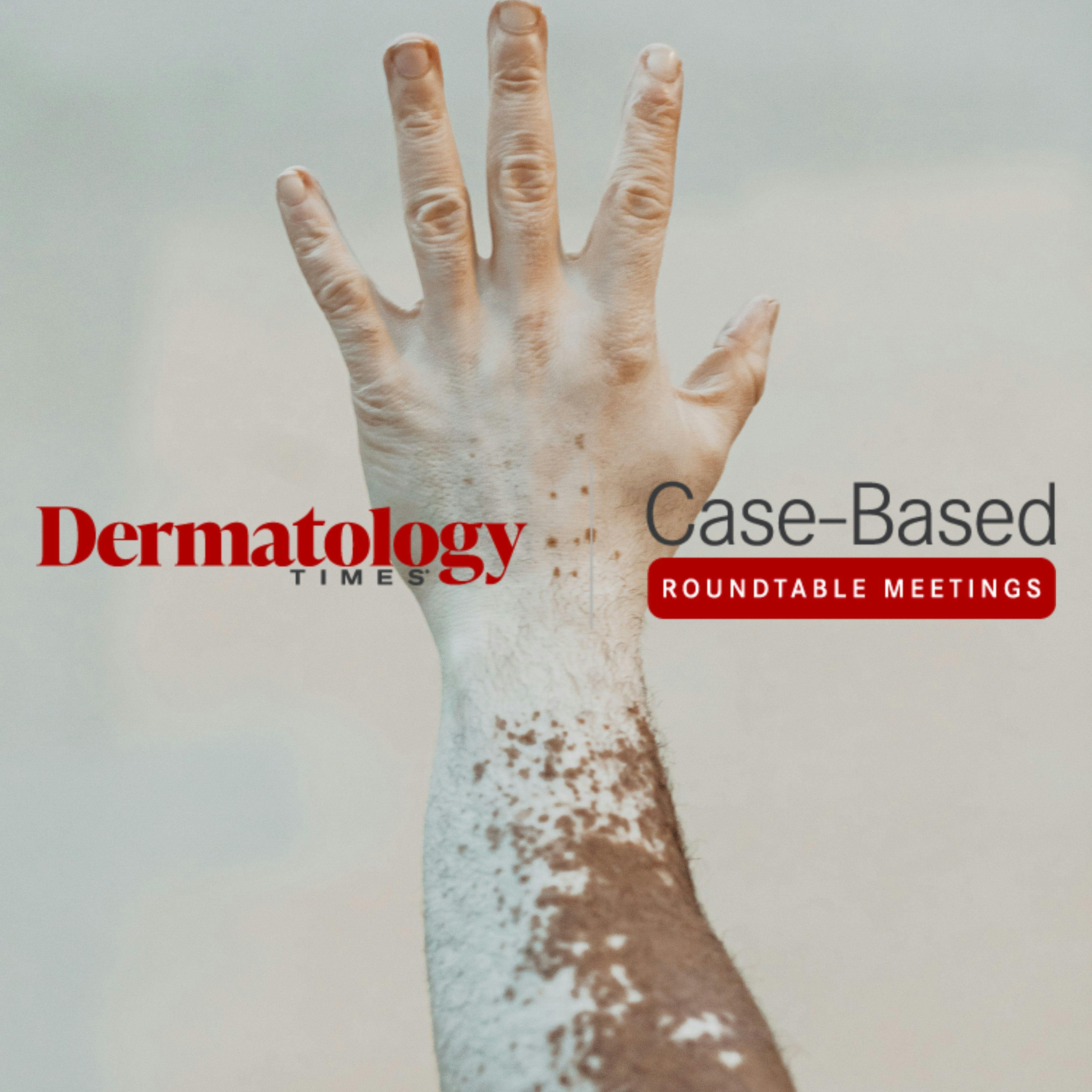 Case Based Roundtables Part 1: Valorizing Topical Treatment Options for Patients With Vitiligo