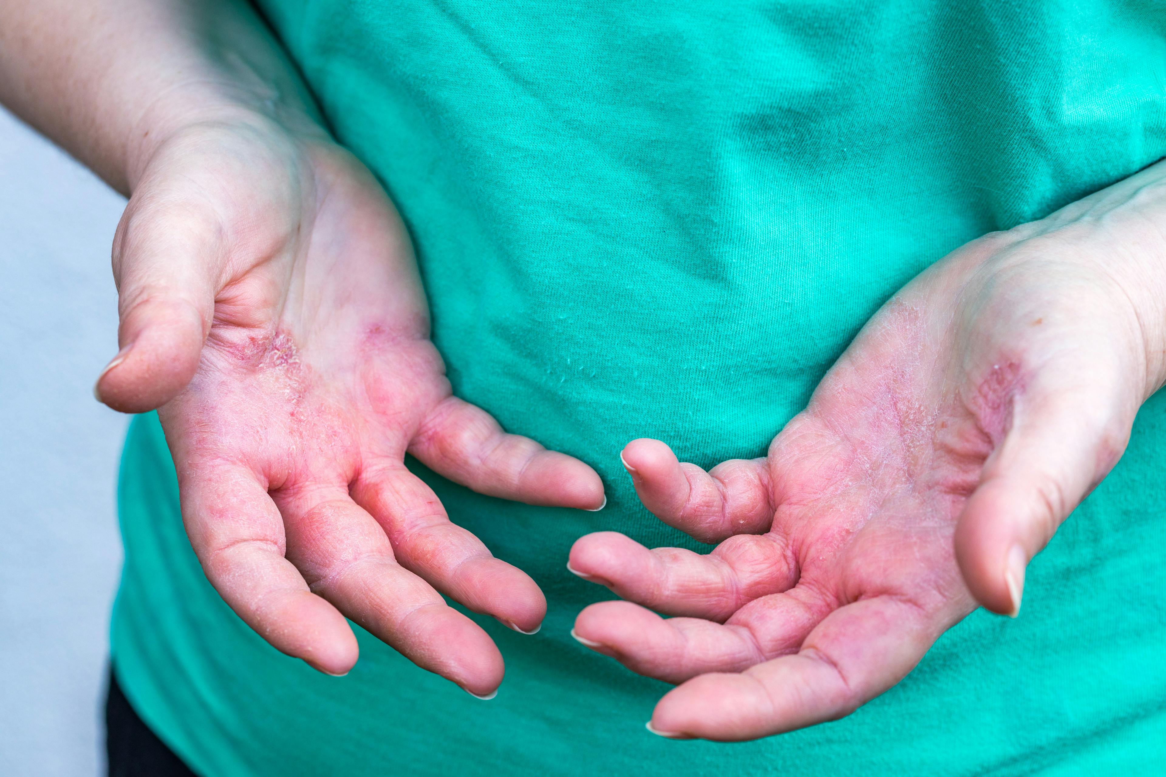 Caregivers and Patients With Atopic Dermatitis Prioritize Symptom Control, Adverse Effect Management