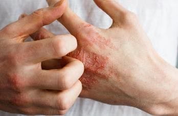 Three-year eczema data show sustained safety, efficacy