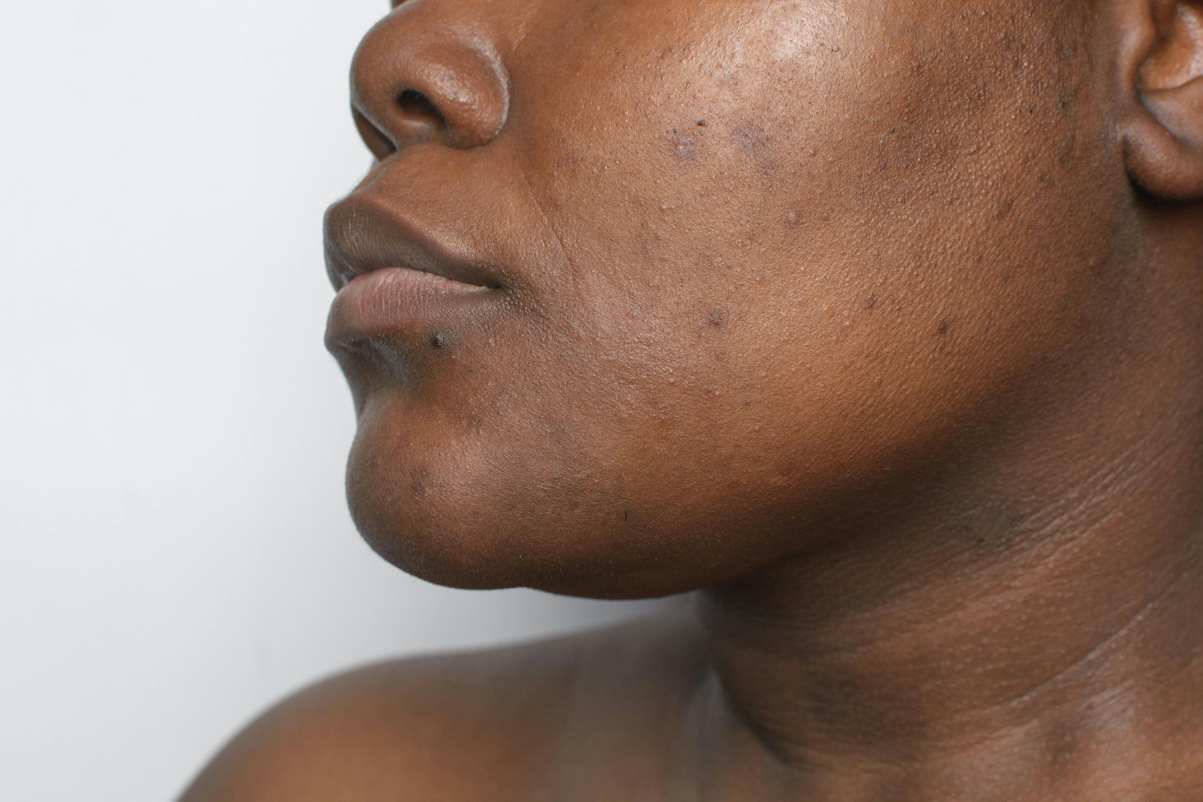 Trifarotene Yields Significant Improvements in Post-Inflammatory Hyperpigmentation