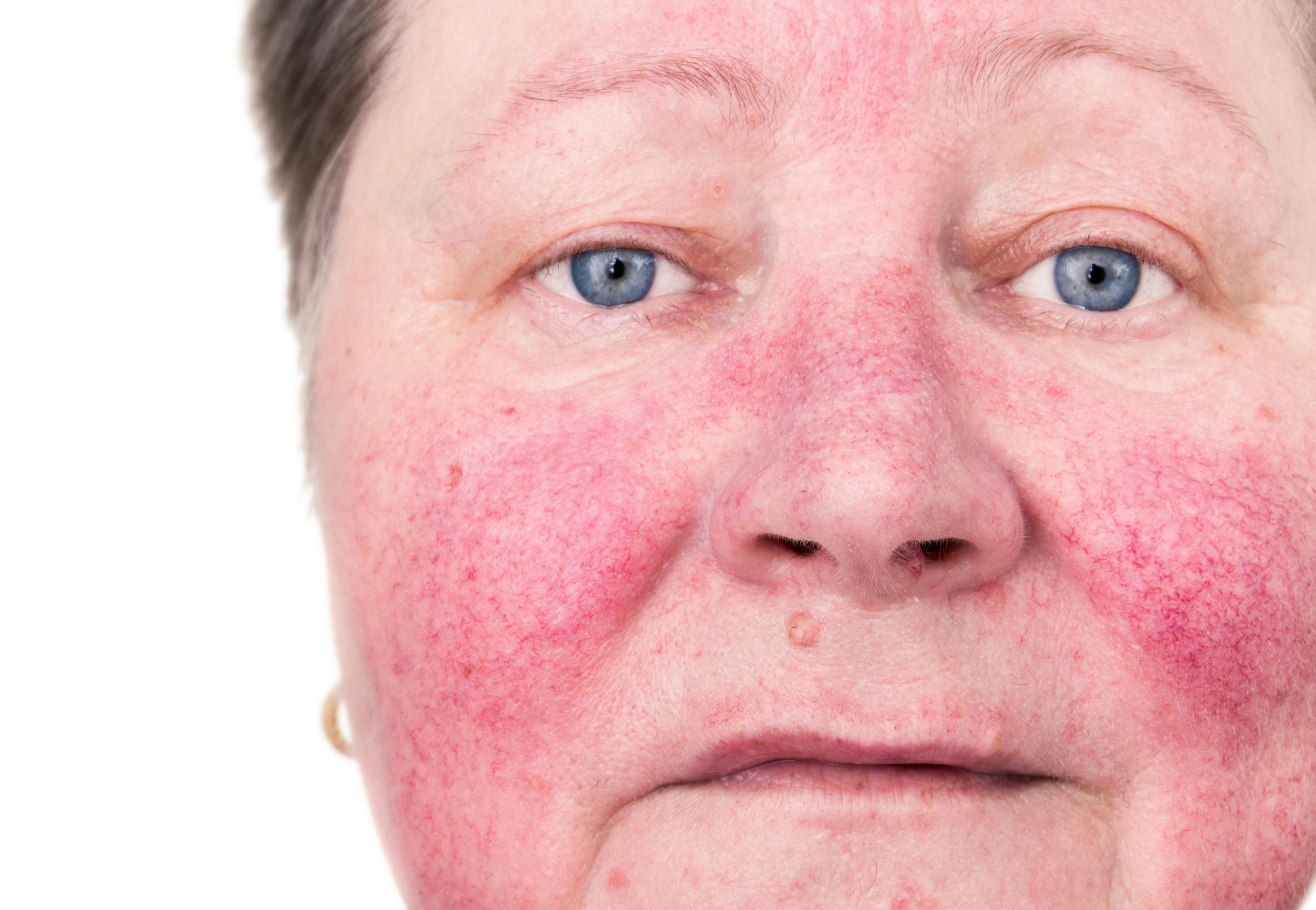 QUIZ RECAP: Test Your Knowledge of Rosacea Research and Innovations