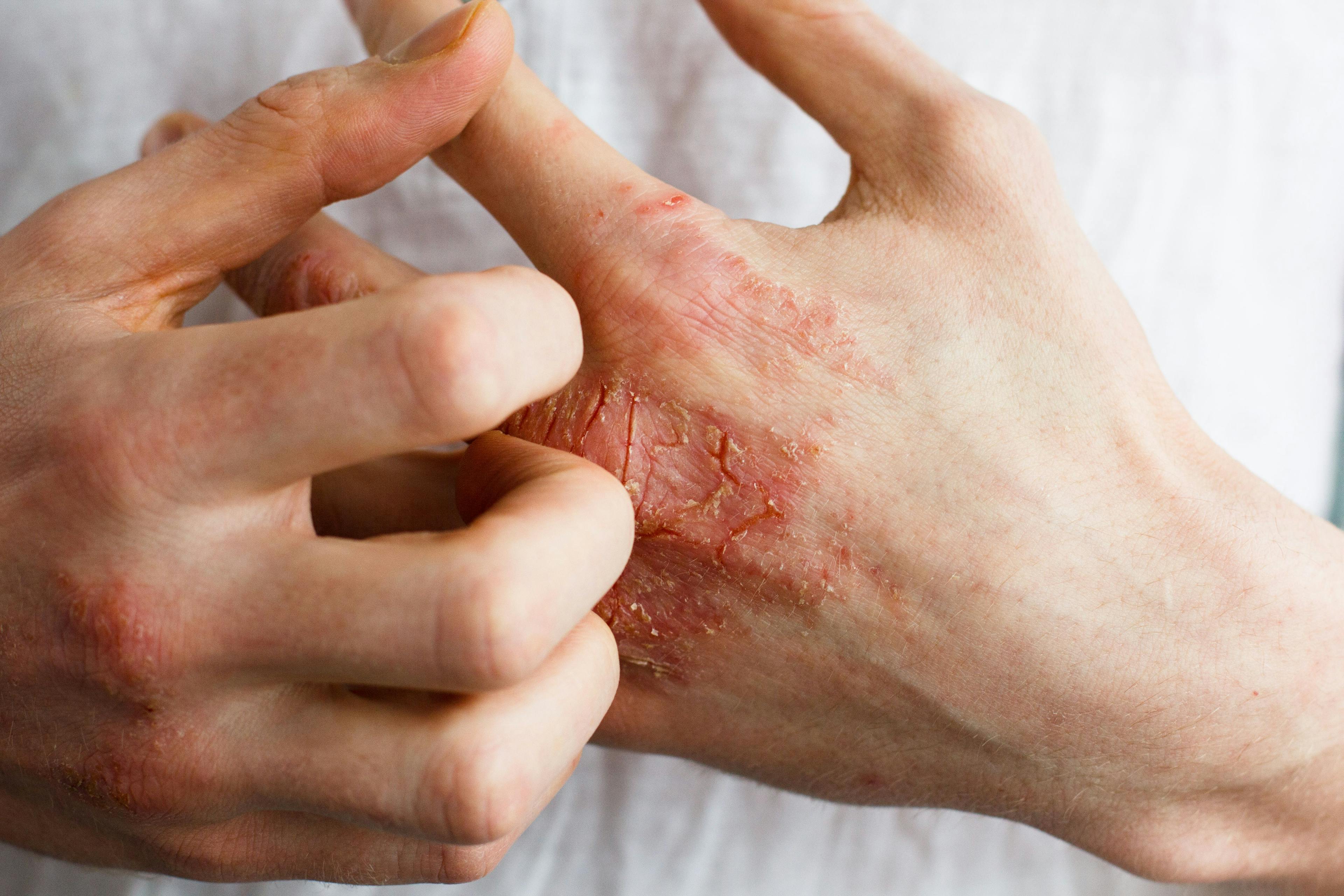 atopic dermatitis on hand
