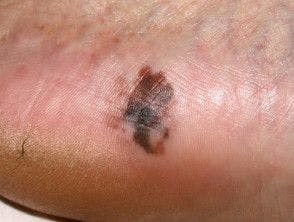 Cutaneous melanoma on the base of a person's foot