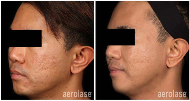 Neoderm by Aerolase