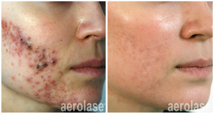 Neoderm by Aerolase