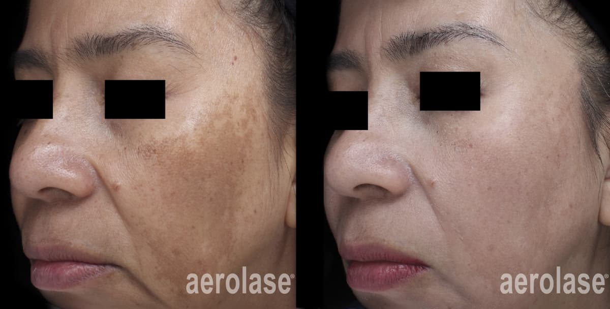 Melasma