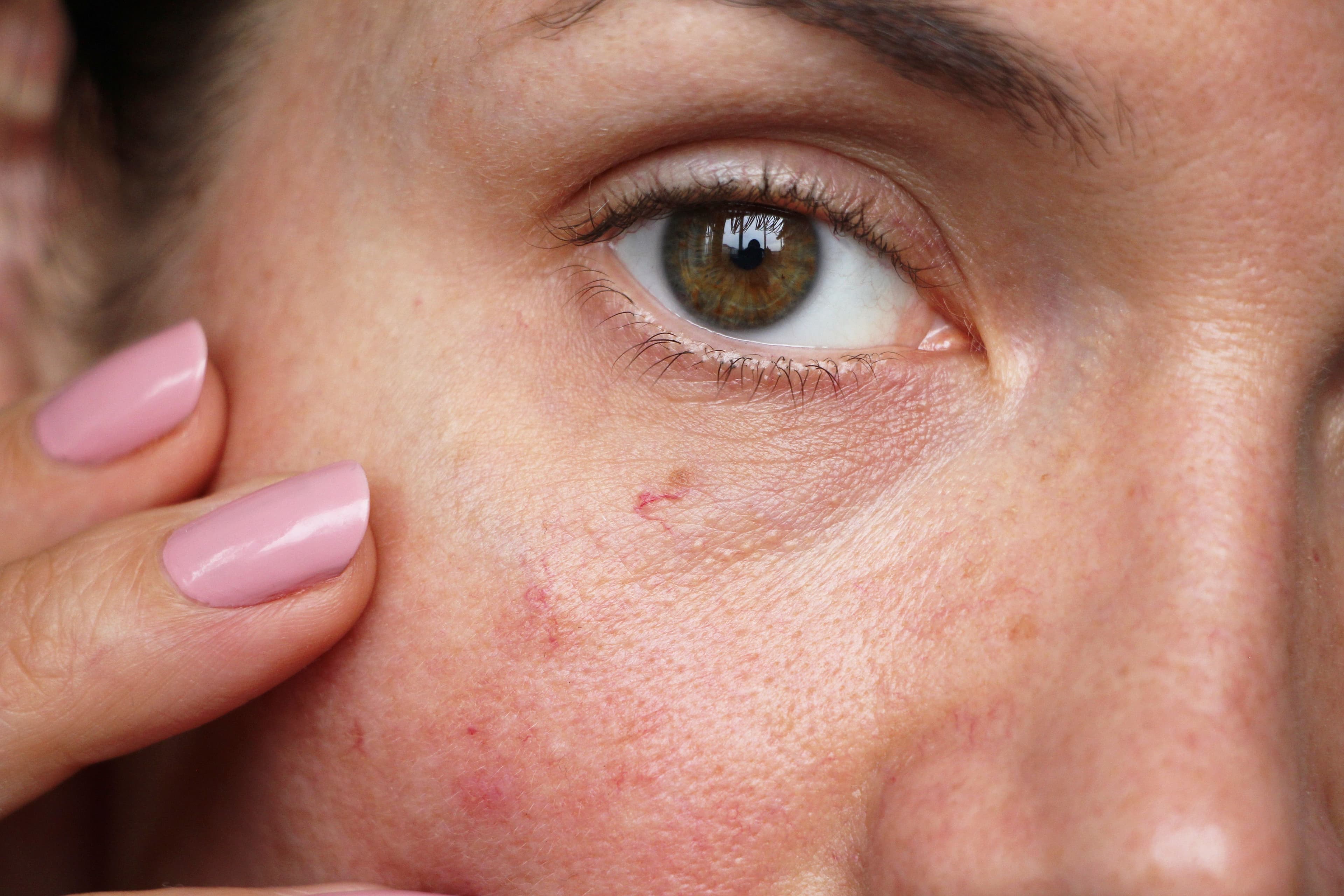 Woman with sensitive skin | Image Credit: © Angelina - stock.adobe.com