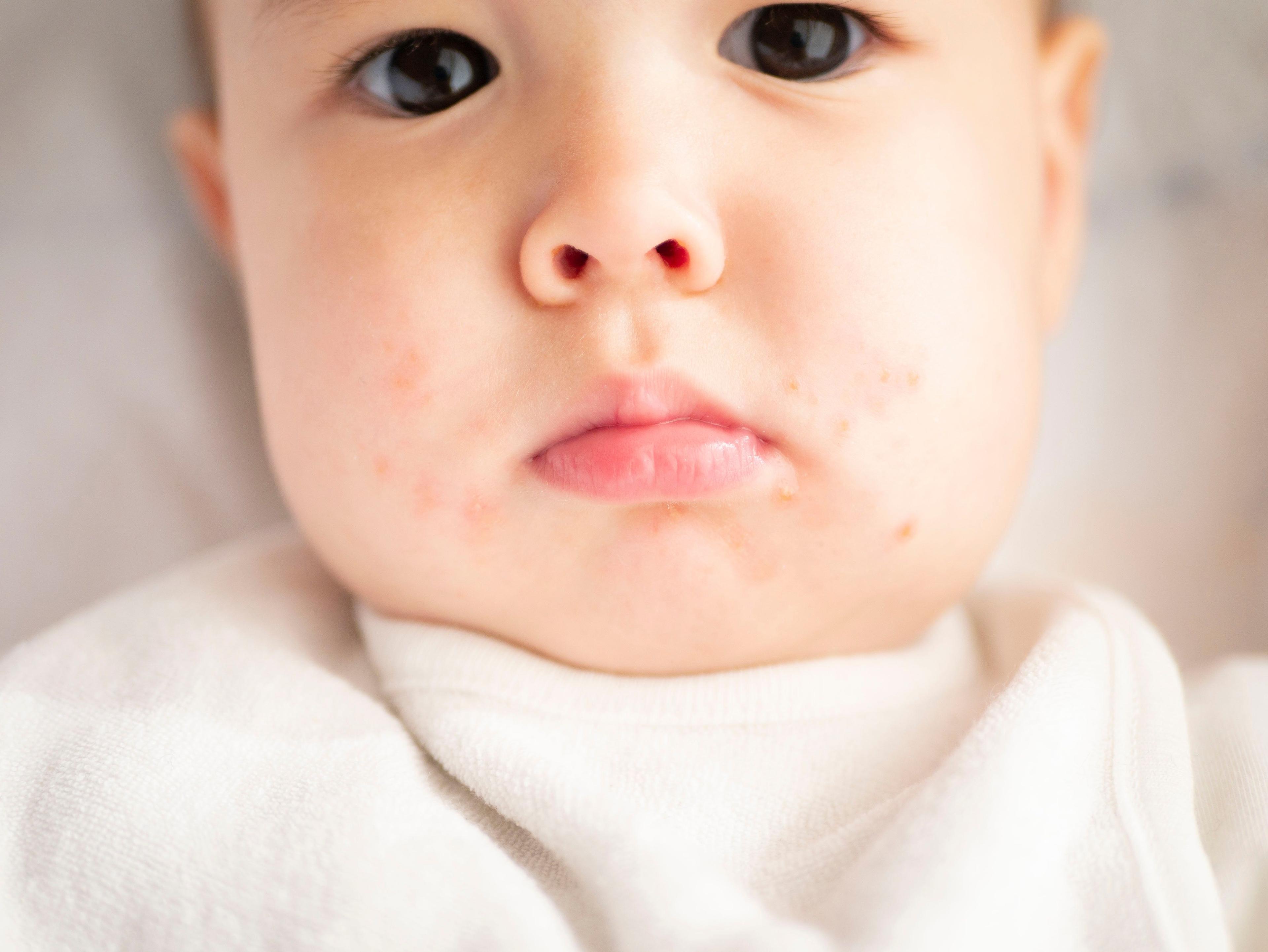 Pediatric Dermatology Update: 2022’s Top Studies 