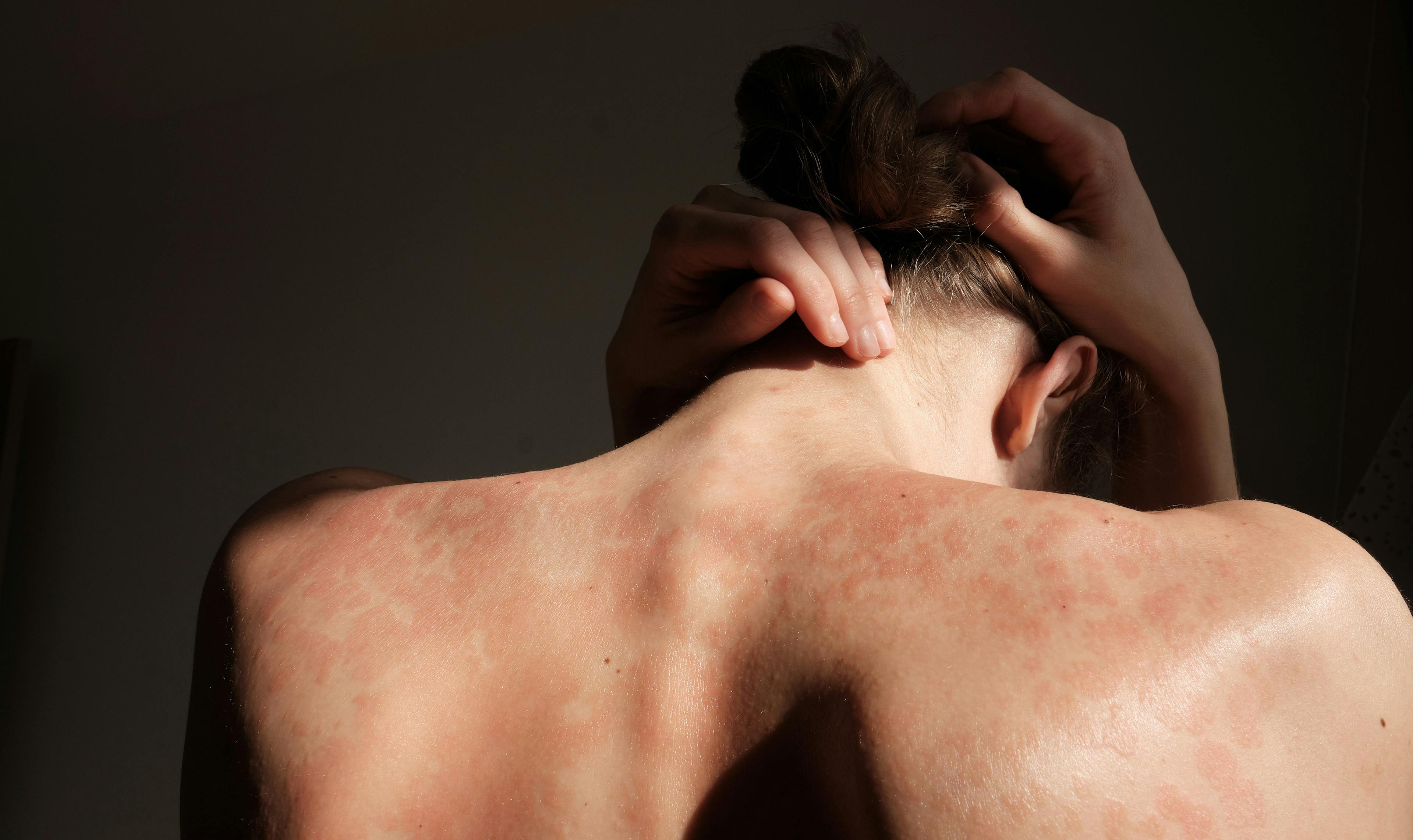 Patient with psoriasis | Image Credit: © stockmaster - stock.adobe.com