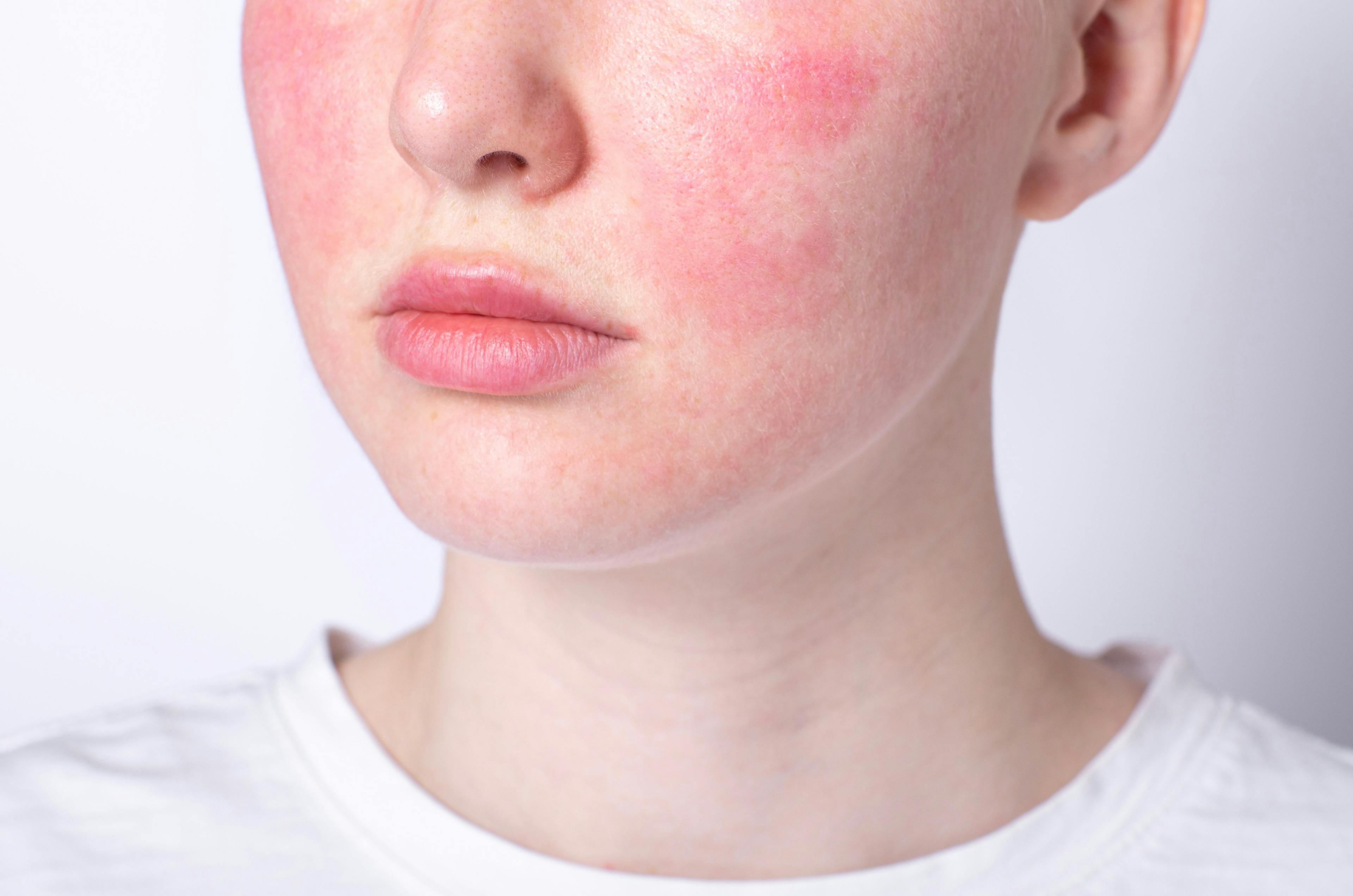 Patient with rosacea | Image Credit: © iso100production - stock.adobe.com