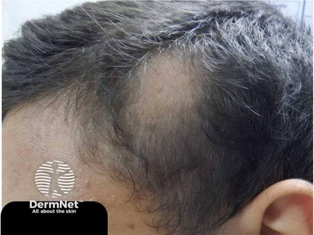 Single patch of alopecia areata | Image credit: DermNet