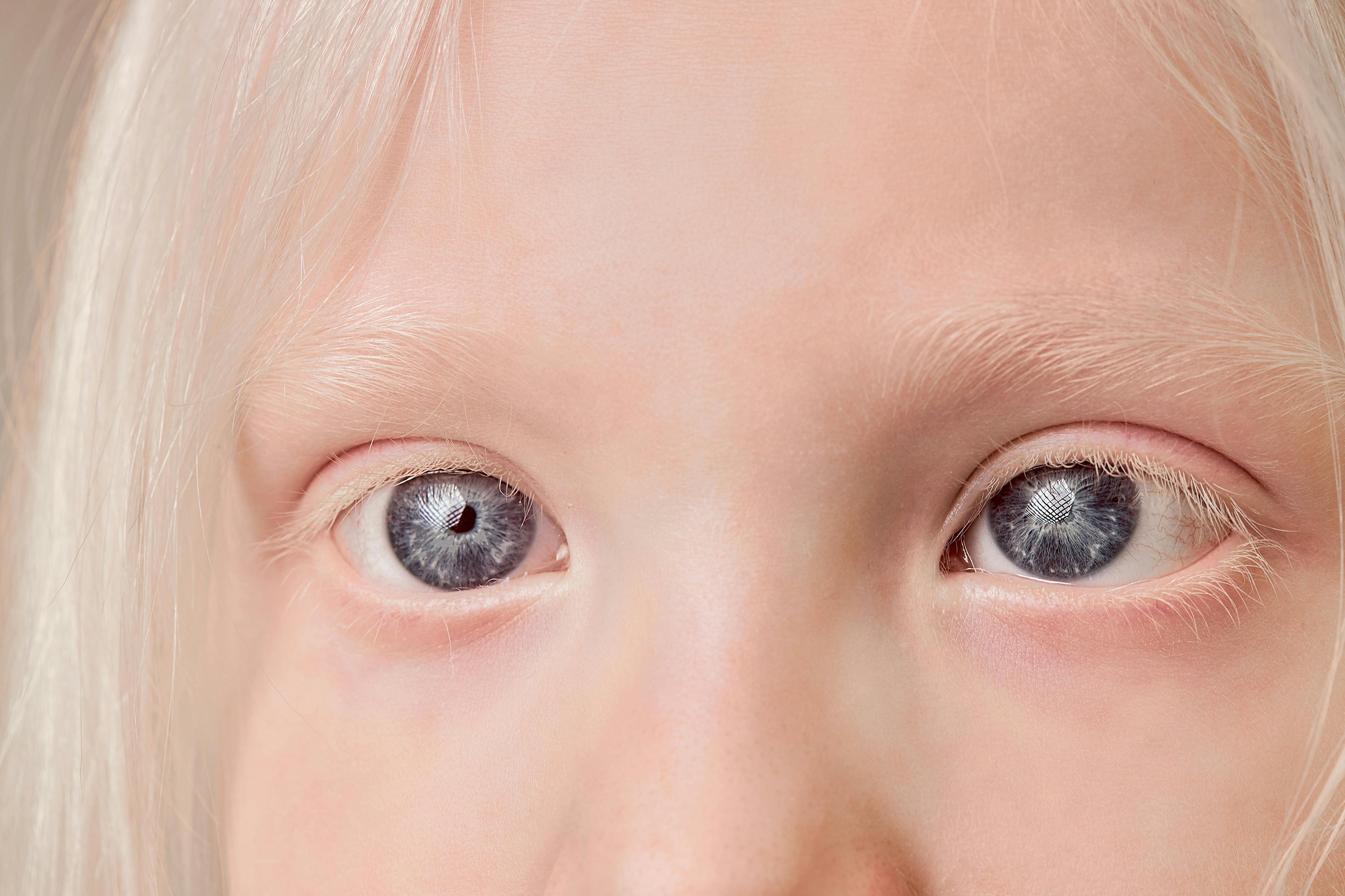 Close up of the eyes and face of a young girl with albinism