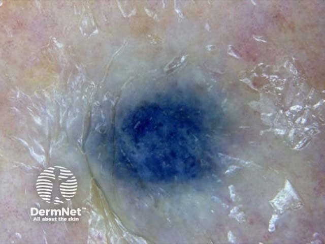 Metastatic melanoma dermoscopy | Image credit: DermNet