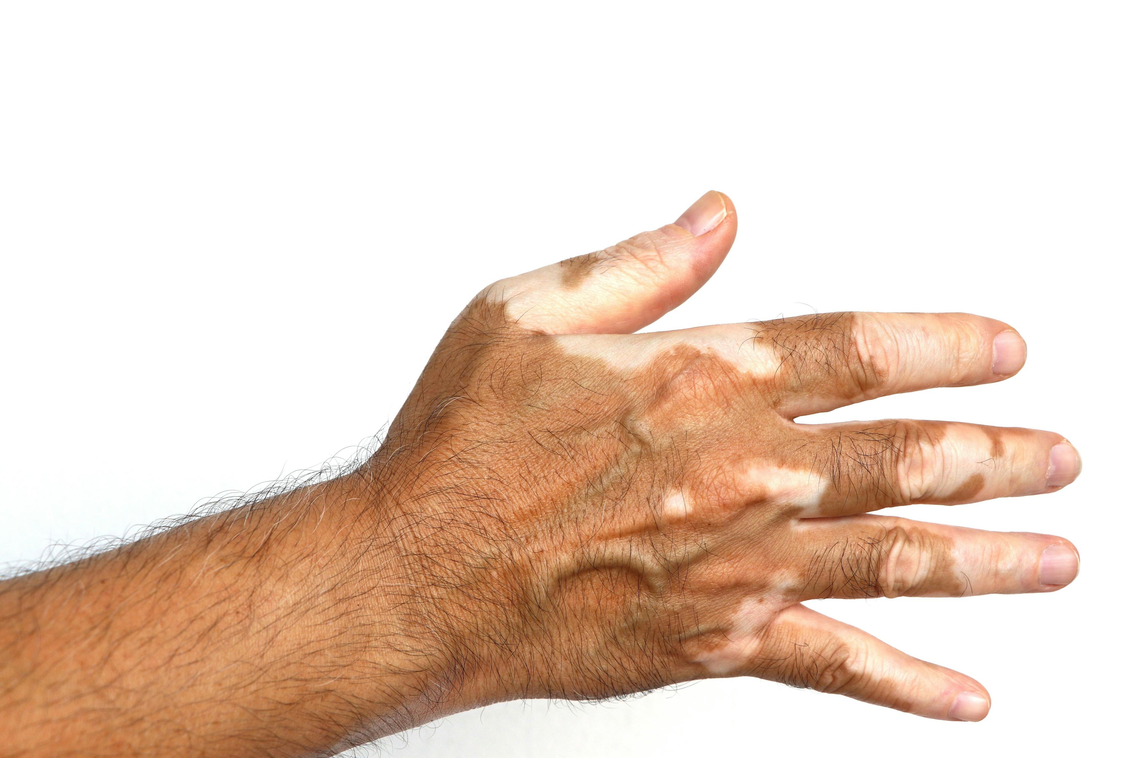 Vitiligo on hand on white isolated background