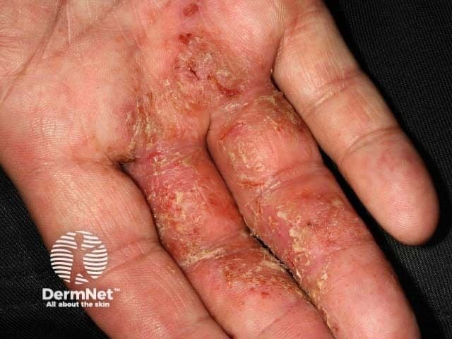 Test Your Knowledge: Chronic Hand Eczema