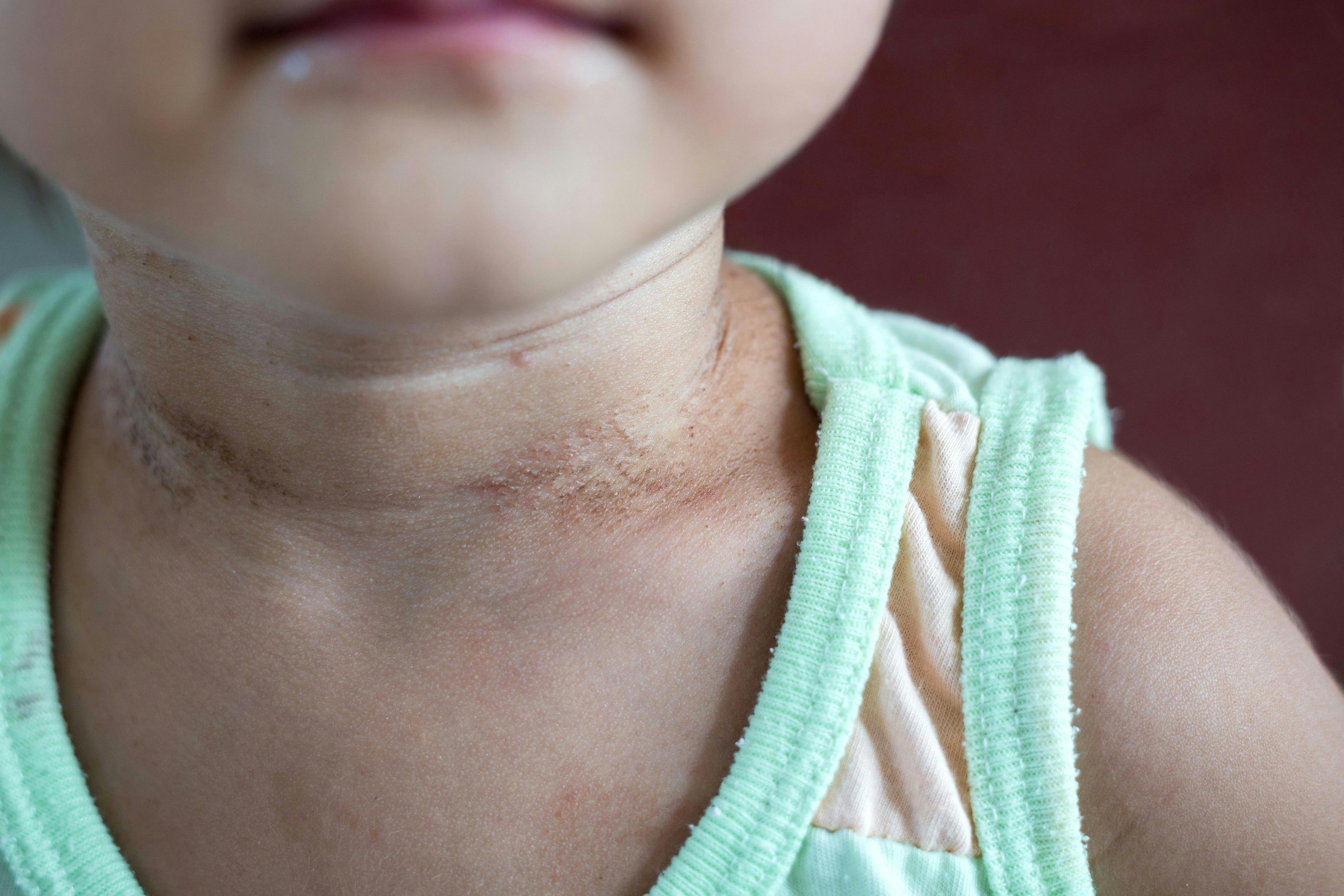 Pediatric patient with atopic dermatitis on the neck | Image Credit: © abimagestudio - stock.adobe.com