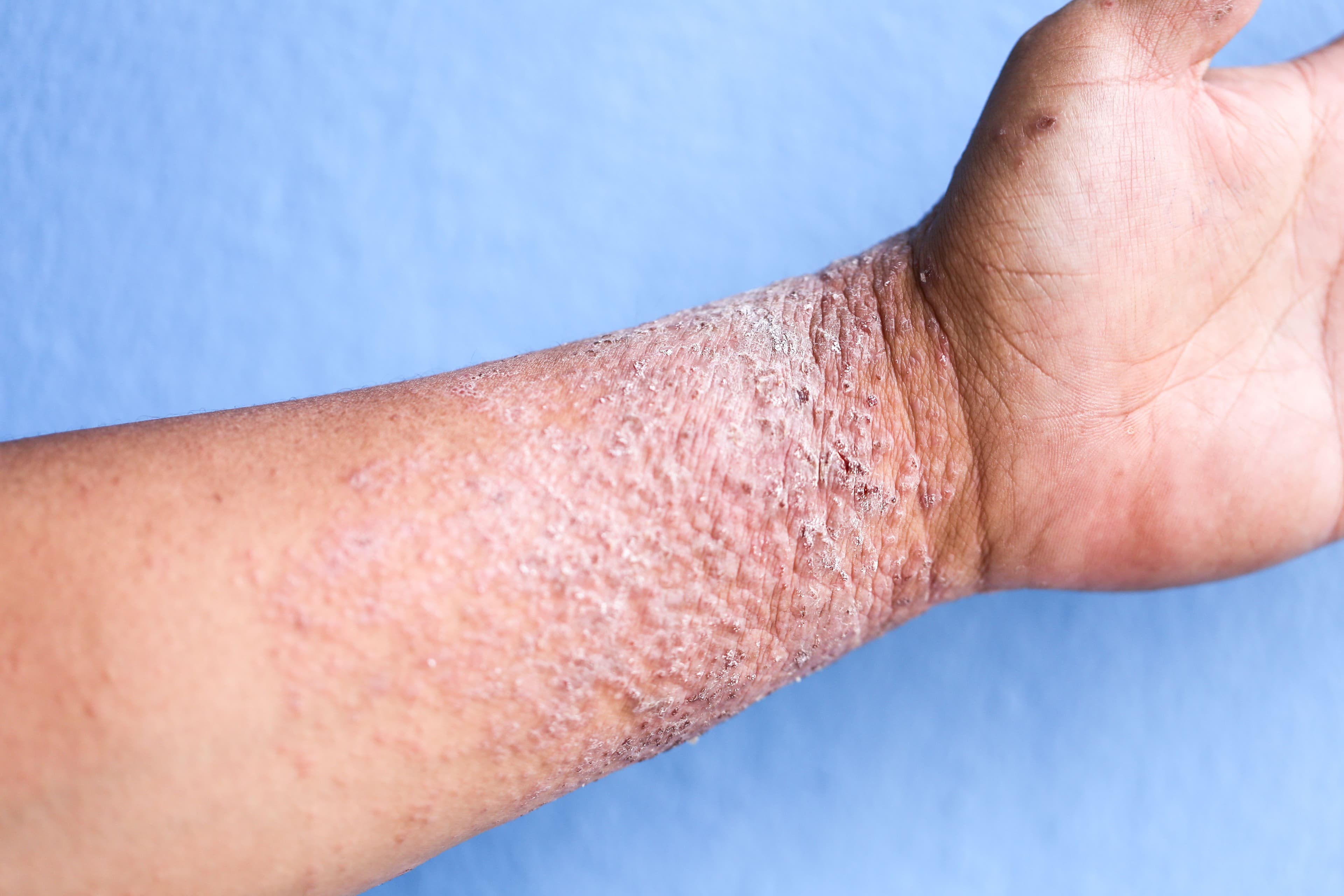 Atopic dermatitis on the arm/wrist