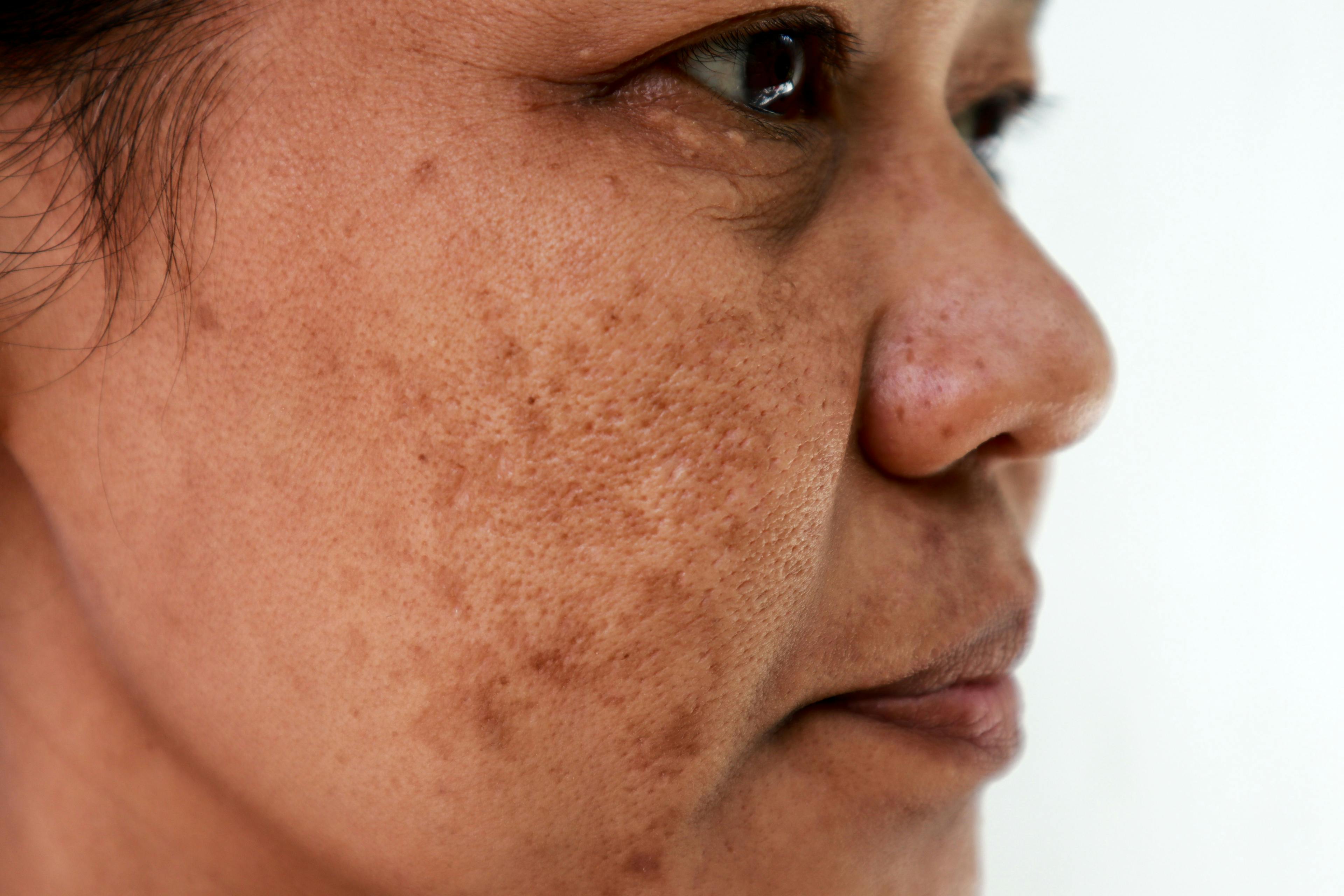 Woman with melasma on the cheeks and face