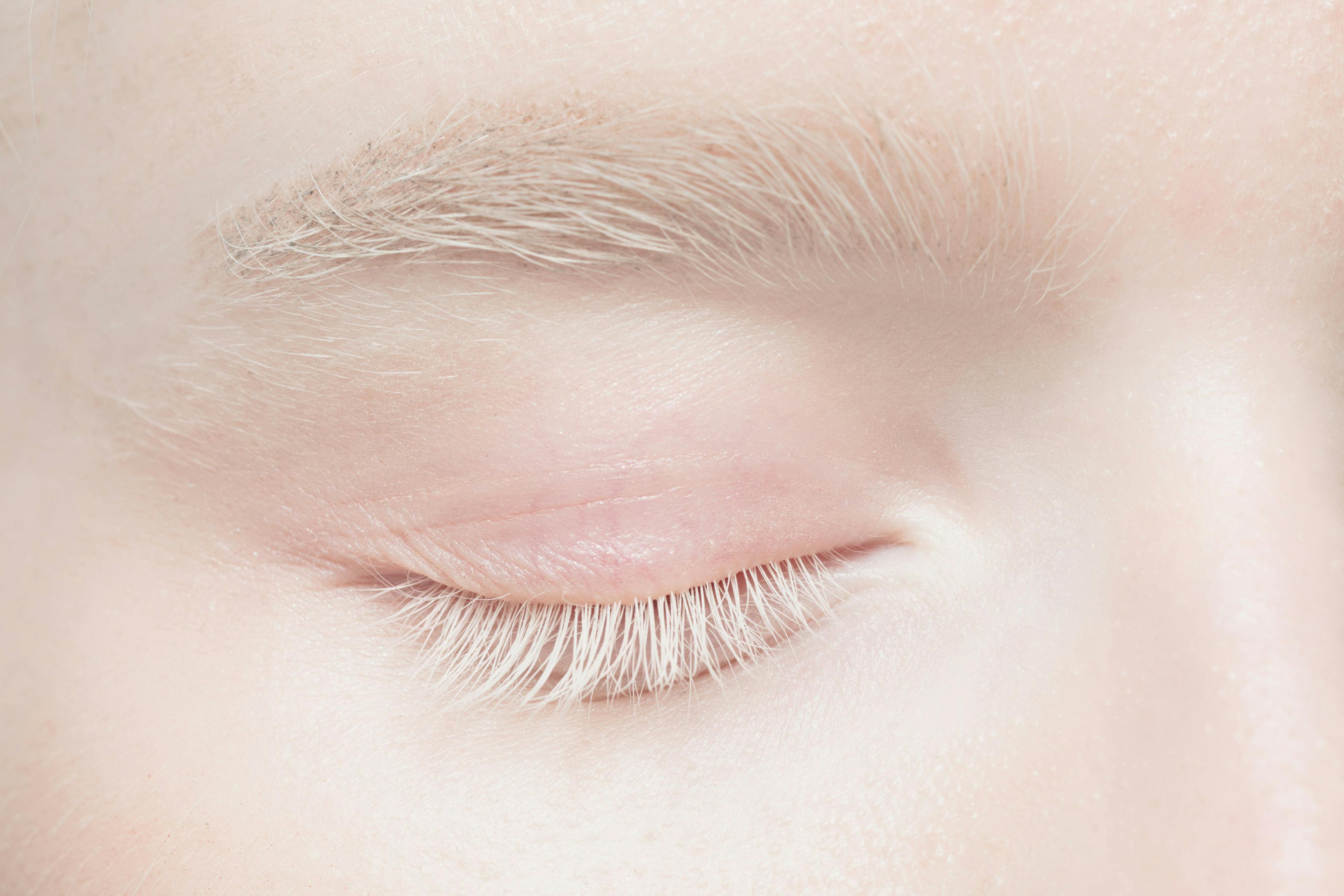 Close up view of eye and eyebrow of person with albinism
