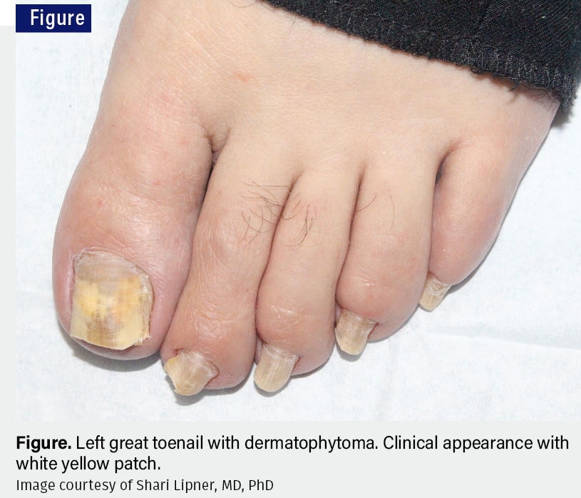 Figure. Left great toenail with dermatophytoma. Clinical appearance with white yellow patch | Image credit: Shari Lipner, MD, PhD
