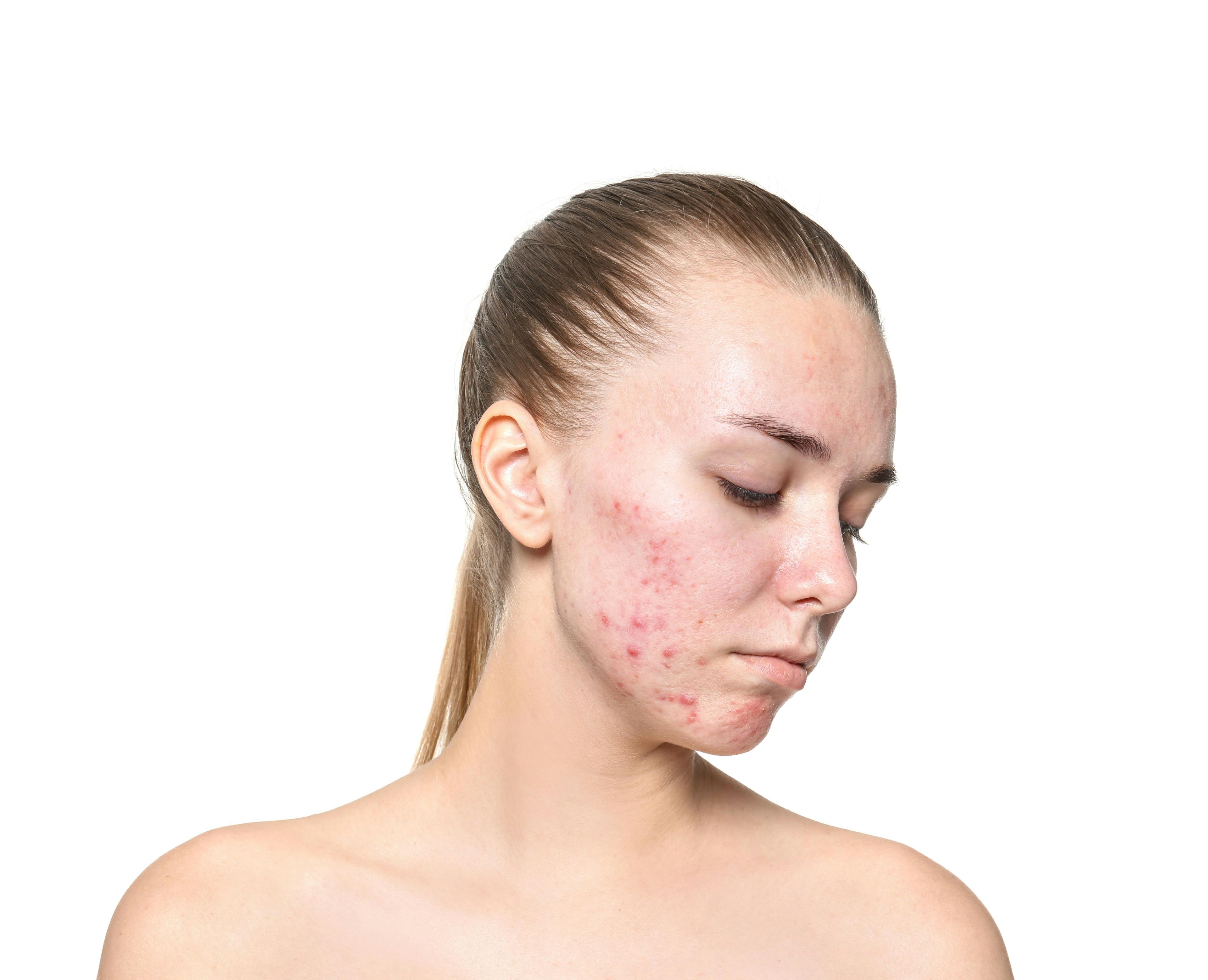 Woman with acne | Image credit: © New Africa - stock.adobe.com